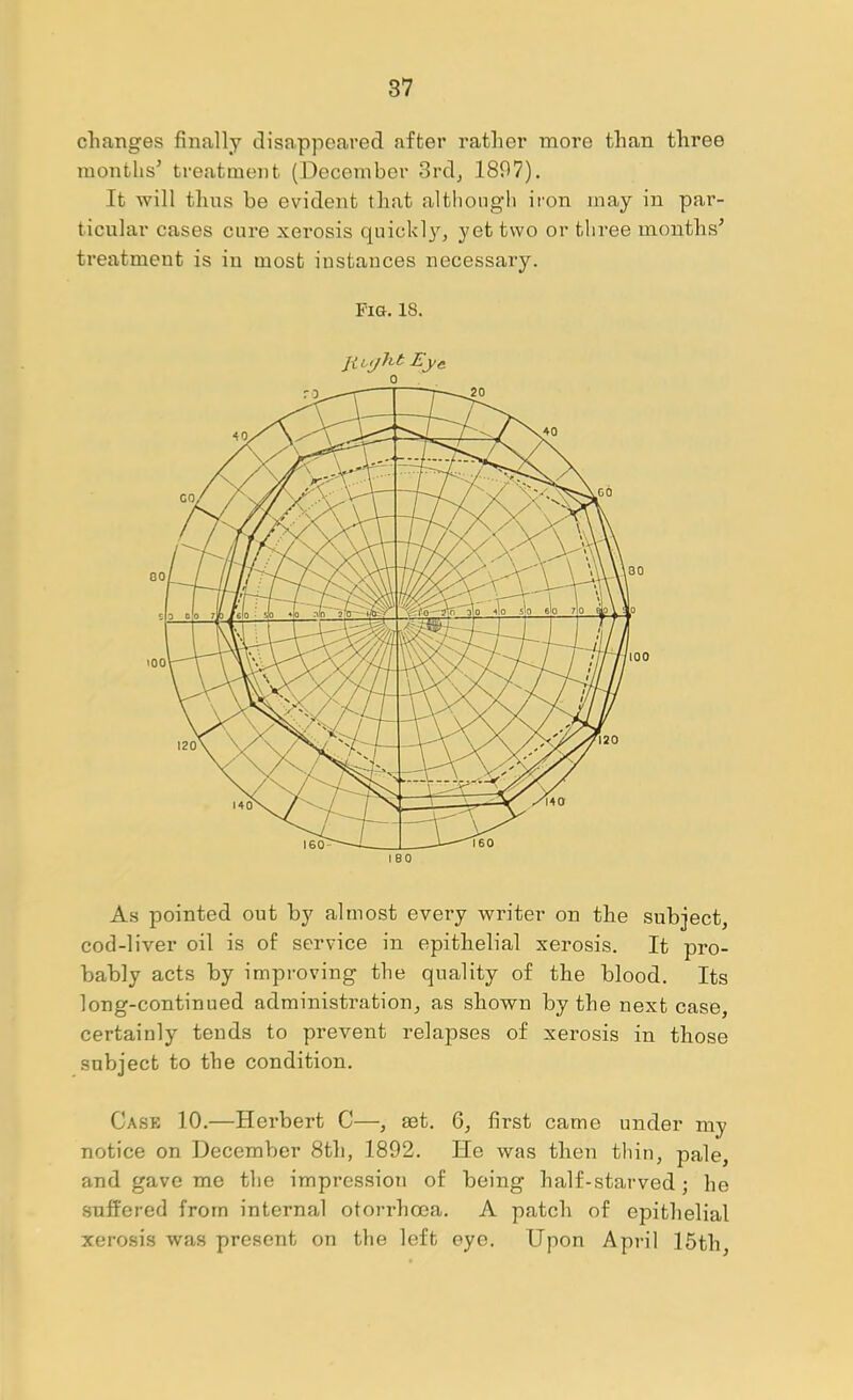 changes finally disappeared after rather more than three months’ treatment (December 3rdj 1897), It will thns be evident that altliongh iron may in par- ticular cases cure xerosis quickl}^, yet two or three months’ treatment is in most instances necessary. Fig. 18. livifht Eye. As pointed out by almost every writer on the subject, cod-liver oil is of service in epithelial xerosis. It pro- bably acts by improving the quality of the blood. Its long-continued administration, as shown by the next case, certainly tends to prevent relapses of xerosis in those subject to the condition. Case 10.—Herbert C—, set. 6, first came under my notice on December 8th, 1892. He was then thin, pale, and gave me the impression of being half-starved; he suffered from internal otorrhoea. A patch of epithelial xerosis was present on the left eye. Upon April 15th,