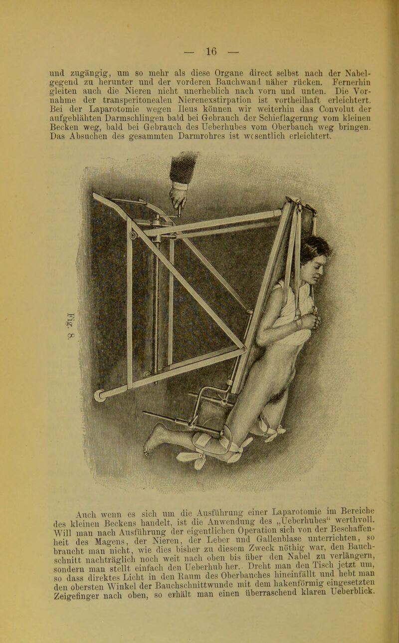 und zugäugig, um so mehr als diese Organe direct selbst nach der Nabel- gegend zu herunter und der vorderen Bauchwand näher rücken. Fernerhin gleiten auch die Nieren nicht unerheblich nach vorn und unten. Die Vor- nahme der transperitonealen Nierenexstirpation ist vortheilhaft erleichtert. Bei der Laparotomie wegen Ileus können wir weiterhin das Convolut der aufgeblähten Darmschlingen bald bei Gebrauch der Schieflagerung vom kleinen Becken weg, bald bei Gebrauch des Ueberhubes vom Oberbauch weg bringen. Das Absnchen des gesainmten Darmrohres ist wesentlich erleichtert. Auch wenn es sich um die Ausführung einer Laparotomie im Bereiche des kleinen Beckens handelt, ist die Anwendung des „Ueberhubes ‘ werthvoll. Will man nach Ausführung der eigentlichen Operation sich von der Beschaffen- heit des Magens, der Nieren, der Leber und Gallenblase iinterrichten, so braucht man nicht, wie dies bisher zu diesem Zweck iiothig war, den Baiich- schiiitt nachträglich noch weit nach oben bis über den Nabel zu veilaii er , sondern man stellt einfach den Ueberhiib her Dreht man_ den I isch .letzt uii , so dass direktes Licht in den Raum des Oberbpdies hineinlallt und hebt mau den obersten Winkel der Bauchschnittwunde mit dem hakeiitormig emgesetzte„ Zeigefinger nach oben, so erhält man einen überraschend klaren Ueberblick.