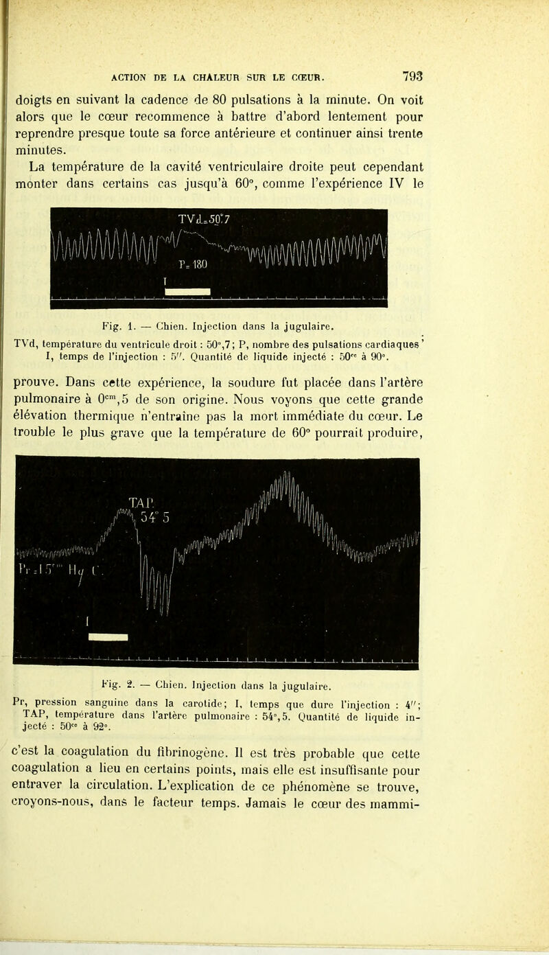 doigts en suivant la cadence de 80 pulsations à la minute. On voit alors que le cœur recommence à battre d’abord lentement pour reprendre presque toute sa force antérieure et continuer ainsi trente minutes. La température de la cavité ventriculaire droite peut cependant monter dans certains cas jusqu’à 60°, comme l’expérience IV le Fig. 1. — Chien. Injection dans la jugulaire. TVd, température du ventricule droit : 50,7; P, nombre des pulsations cardiaques’ I, temps de l’injection : 5. Quantité de liquide injecté : 50 à 90°. prouve. Dans cette expérience, la soudure fut placée dans l’artère pulmonaire à 0cm,5 de son origine. Nous voyons que cette grande élévation thermique n’entraîne pas la mort immédiate du cœur. Le trouble le plus grave que la température de 60° pourrait produire, Fig. 2. — Chien. Injection dans la jugulaire. Pr, pression sanguine dans la carotide; I, temps que dure l'injection : kn; TAP, température dans 1 artère pulmonaire : 54,5. Quantité de liquide in- jecté : 50 à 92°. c’est la coagulation du fibrinogène. 11 est très probable que cette coagulation a lieu en certains points, mais elle est insuffisante pour entraver la circulation. L’explication de ce phénomène se trouve, croyons-nous, dans le facteur temps. Jamais le cœur des mammi-