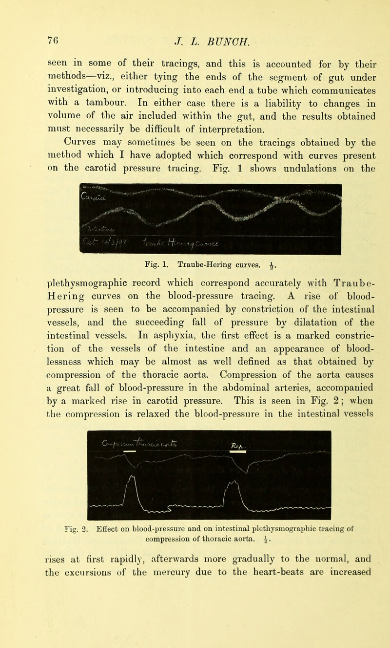 seen in some of their tracings, and this is accounted for by their methods—viz., either tying the ends of the segment of gut under investigation, or introducing into each end a tube which communicates with a tambour. In either case there is a liability to changes in volume of the air included within the gut, and the results obtained must necessarily be difficult of interpretation. Curves may sometimes be seen on the tracings obtained by the method which I have adopted which correspond with curves present on the carotid pressure tracing. Fig. 1 shows undulations on the KsCL'LfoxL- ^«P'v;,5S( V ' ■ 1 ' 1 Q h (t/i/iij? e. He, Fig. 1. Traube-Hering curves. plethysmographic record which correspond accurately with Traube- Hering curves on the blood-pressure tracing. A rise of blood- pressure is seen to be accompanied by constriction of the intestinal vessels, and the succeeding fall of pressure by dilatation of the intestinal vessels. In asphyxia, the first effect is a marked constric- tion of the vessels of the intestine and an appearance of blood- lessness which may be almost as well defined as that obtained by compression of the thoracic aorta. Compression of the aorta causes a great fall of blood-pressure in the abdominal arteries, accompanied by a marked rise in carotid pressure. This is seen in Fig. 2; when the compression is relaxed the blood-pressure in the intestinal vessels Fig. 2. Effect on blood-pressure and on intestinal plethysmographic tracing of compression of thoracic aorta. rises at first rapidly, afterwards more gradually to the normal, and the excursions of the mercury due to the heart-beats are increased