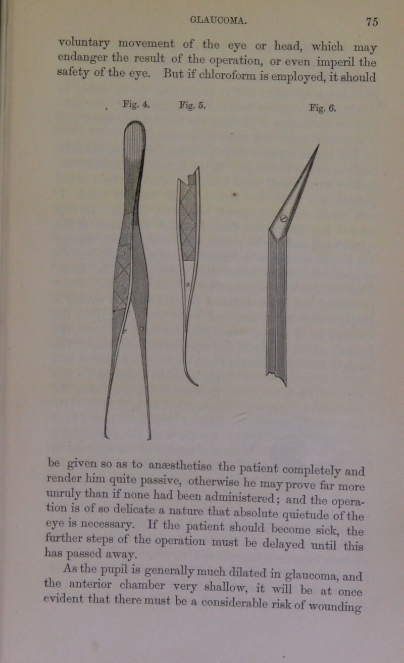voluntary movement of the eye or head, which may endanger the result of the operation, or even imperil the safety of the eye. But if chloroform is employed, it sliould . Fig. 4. Fig. 6. Fig. 6. be pven so as to ansethetise the patient completely and render lum qmte passive, otherwise he may prove far more miruly than if none had been administered; and the opera- tion is of so dehcate a nature that absolute quietude of the eye IS necessary. If the patient should become sick, the further steps of the operation must be delayed until this has passed away. As the pupil is generally much dilated in glaucoma, and the antenor chamber very shallow, it will be at once evident that there must be a considerable risk of wounding