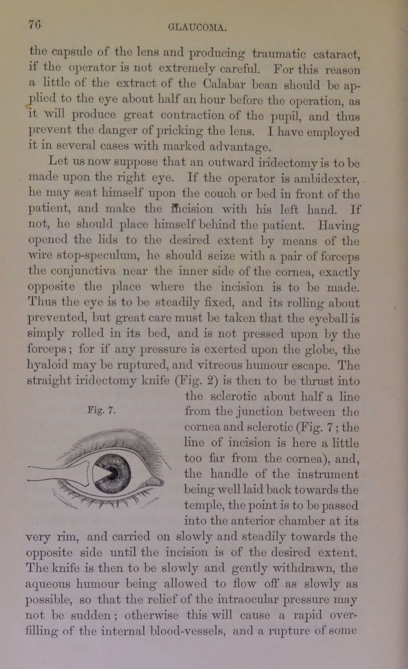 70 tlic cajosule of tlie lens and producing traumatic cataract, if the operator is not extremely careful. For this reason a little of the extract of the Calabar bean should be ap- ])lied to the eye about half an hour before the operation, as it will produce great contraction of the pupil, and thus prevent the danger of pricking the lens. I have employed it in several cases vutli marked advantage. Let us now suppose that an outward iridectomy is to be made upon the right eye. If the operator is ambidexter, he may seat himself upon the couch or bed in front of the patient, and juake the fTicision with his left hand. If not, he should place himself behind the patient. Having ojicned the lids to the desired extent by means of the wire stop-speculum, he should seize with a pair of forceps the conjunctiva near the inner side of the cornea, exactly opposite the place where the incision is to be made. Thus the eye is to be steadily fixed, and its rolling about prevented, but great care must be taken that the eyeball is simply rolled in its bed, and is not pressed upon by the forceps; for if any pressme is exerted upon the globe, the hyaloid may be ruptimed, and vitreous humour escape. The straight iridectomy knife (Fig. 2) is then to be thi-ust into the sclerotic about half a line cornea and sclerotic (Fig. 7 ; the line of incision is here a little too far from the cornea), and, the handle of the instmment being well laid back towards the temple, the jioint is to be passed into the anterior chamber at its very rim, and earned on slowly and steadily towards the opposite side until the incision is of the desired extent. The knife is then to be slowly and gently vdthdrawn, the aqueous humour being allowed to flow off as slowly as possible, so that the relief of the intraocular pressure may not be sudden; othenrise this will cause a rapid oveiv filling of the internal blood-vessels, and a rupture of some