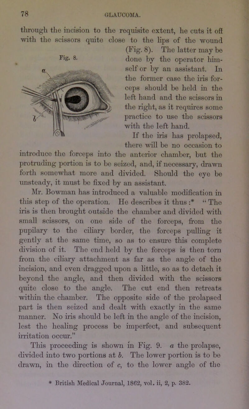 through the incision to the requisite extent, lie cuts it off ^vith the scissors quite close to the lips of the wound (Fig. 8). The latter may be done by the operator him- self or by an assistant. In the former case the iris for- ceps should be held in the left hand and the scissors in the right, as it requii’cs some practice to use the scissors with the left hand. If the iris has prolapsed, there -will be no occasion to introduce the forceps into the antenor chamber, but the protruding portion is to be seized, and, if necessaiy, di’awn forth somewhat more and divided. Should the eye be unsteady, it must be fixed by an assistant. Mr. Bowman has introduced a valuable modification in this step of the operation. He describes it thus :* “ The iris is then brought outside the chamber and divided Avith small scissors, on one side of the forceps, fi'ora the pupilary to the cihary border, the forceps pulling it gently at the same time, so as to ensure this complete division of it. The end held by the forceps is then tom from the ciliary attachment as far as the angle of the incision, and CA’’en dragged upon a little, so as to detach it beyond the angle, and then divided Avith the scissors quite close to the angle. The cut end then retreats Avithin the chamber. The opposite side of the prolapsed part is then seized and dealt Avith exactly in the same manner. No iris should be left in the angle of the incision, lest the healing process be imperfect, and subsequent in’itation occur.” This proceeding is shoAvn in Fig. 9. a the prolapse, divided into tAvo portions at h. The lower portion is to be drawn, in the direction of c, to the loAver angle of the Fig. 8. * British Medical Journal, 1862, vol. ii, 2, p. 382.