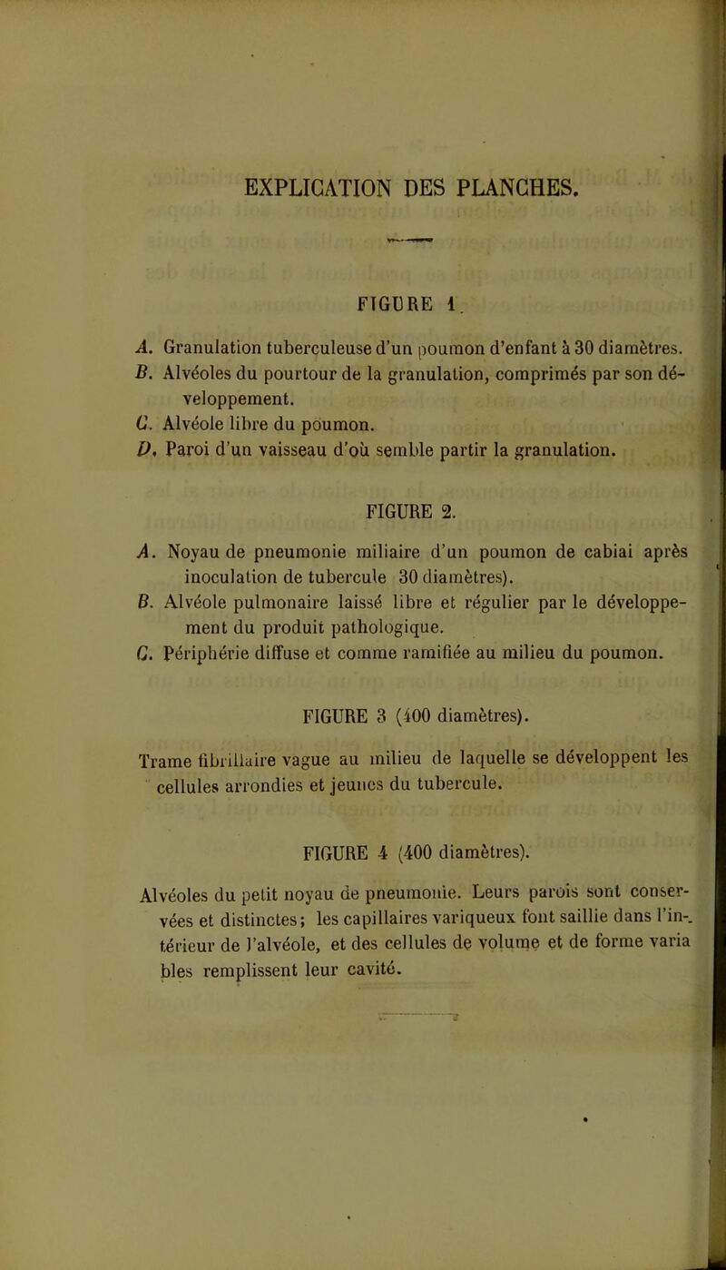 EXPLICATION DES PUNGHES. FIGURE 1. A. Granulation tuberculeuse d’un poumon d’enfant à 30 diamètres. B. Alvéoles du pourtour de la granulation, comprimés par son dé- veloppement. C. Alvéole libre du poumon. P, Paroi d’un vaisseau d’où semble partir la granulation. FIGURE 2. A. Noyau de pneumonie miliaire d’un poumon de cabiai après inoculation de tubercule 30 diamètres). B. Alvéole pulmonaire laissé libre et régulier par le développe- ment du produit pathologique. C. Périphérie diffuse et comme ramifiée au milieu du poumon. FIGURE 3 (400 diamètres). Trame tibriliaire vague au milieu de laquelle se développent les cellules arrondies et jeunes du tubercule. FIGURE 4 (400 diamètres). Alvéoles du petit noyau de pneumonie. Leurs parois sont conser- vées et distinctes; les capillaires variqueux font saillie dans l’in-, térieur de l’alvéole, et des cellules de volume et de forme varia blés remplissent leur cavité.