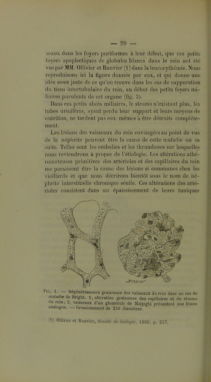 seaux clans les foyers puriformes à leur début, que ces petits loyers apoplectiques de globules blancs dans le rein ont été vus par MM. Ollivier et Ranvier (1 ) dans la leucocytbémie. Nous reproduisons ici la figure donnée par eux, et qui donne une idée assez juste de ce qu’on trouve dans les cas de suppuration du tissu intertubulaire du rein, au début des petits foyers mi- liaires purulents de cet organe (fig. 3). Dans ces petits abcès miliaires, le stroma n’existant plus, les tubes urinifères, ayant perdu leur support et leurs moyens de nutrition, ne tardent pas eux-mêmes à être détruits complète- ment. Les lésions des vaisseaux du rein envisagées au point de vue de la néphrite peuvent être la cause de cette maladie ou sa suite. Telles sont les embolies et les thromboses sur lesquelles nous reviendrons à propos de l’étiologie. Les altérations athé- romateuses primitives des artérioles et des capillaires du rein me paraissent être la cause des lésions si communes chez les vieillards et que nous décrirons bientôt sous le nom de né- phrite interstitielle chronique sénile. Ces altérations des arté- rioles consistent dans un épaississement de leurs tuniques . Dégénérescence graisseuse des vaisseaux du rein dans un cas de maladie de Bright. 1, altération graisseuse des capillaires et du stroma tu rein, 2, vaisseaux d’un glomérulc de Malpighi présentant une lésion analogue. ■—Grossissement de 250 diamètres. (1) Ollivier et Ranvier, Société de biolo'jic, 18üG, p. 257.