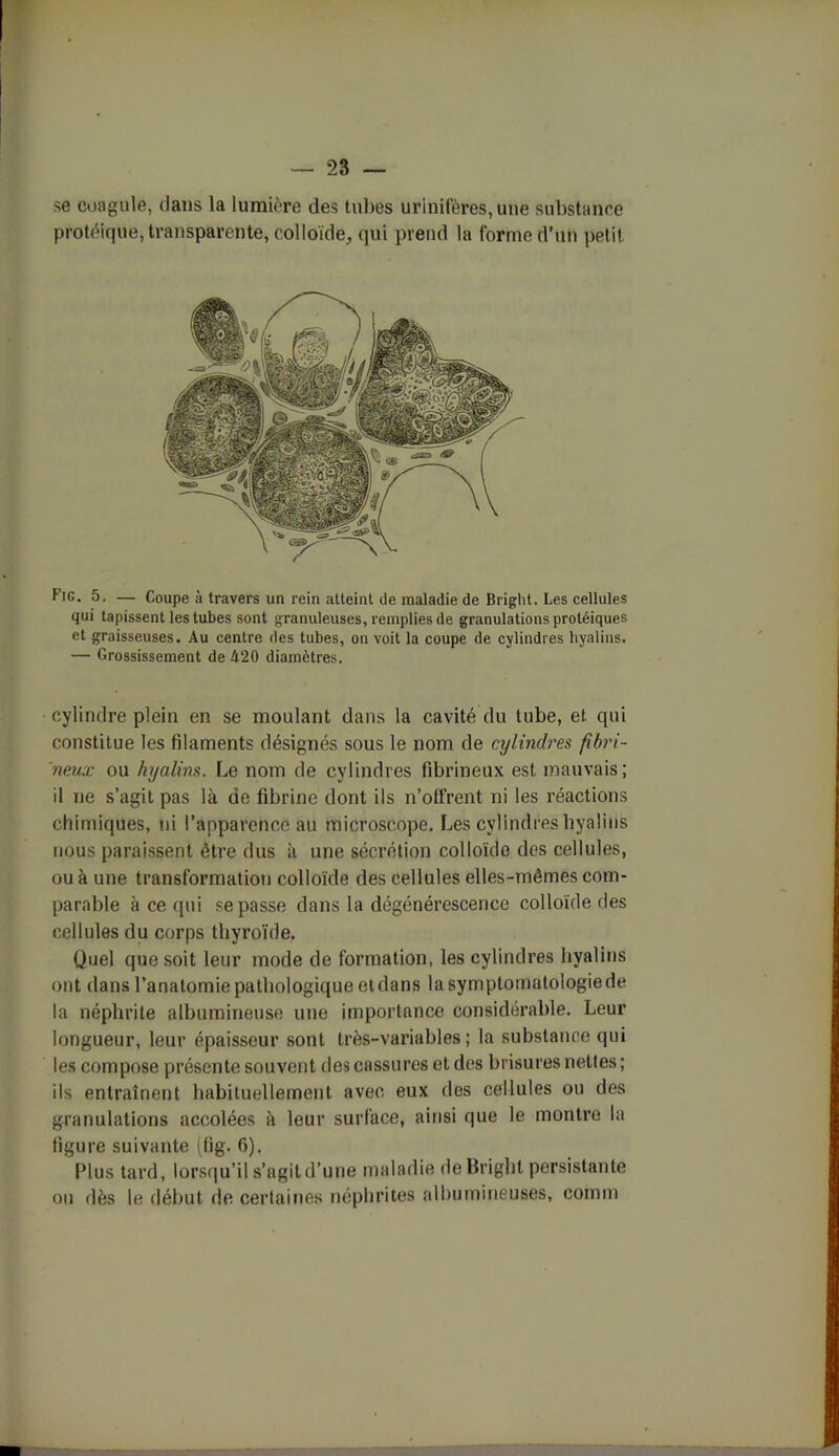 se coagule, dans la lumière des tubes urlnifères, une substance protéique, transparente, colloïde, qui prend la forme d’un petit Fig. 5. — Coupe à travers un rein atteint de maladie de Bright. Les cellules qui tapissent les tubes sont granuleuses, remplies de granulations protéiques et graisseuses. Au centre des tubes, on voit la coupe de cylindres hyalins. — Grossissement de 420 diamètres. cylindre plein en se moulant dans la cavité du tube, et qui constitue les filaments désignés sous le nom de cylindres fibri- neux ou hyalins. Le nom de cylindres fibrineux est mauvais; il ne s’agit pas là de fibrine dont ils n’offrent ni les réactions chimiques, ni l’apparence au microscope. Les cylindres hyalins nous paraissent être dus il une sécrétion colloïde des cellules, ou à une transformation colloïde des cellules elles-mêmes com- parable à ce qui se passe dans la dégénérescence colloïde des cellules du corps thyroïde. Quel que soit leur mode de formation, les cylindres hyalins ont dans l’anatomie pathologique et dans la symptomatologiede la néphrite albumineuse une importance considérable. Leur longueur, leur épaisseur sont très-variables ; la substance qui les compose présente souvent des cassures et des brisures nettes; ils entraînent habituellement avec eux des cellules ou des granulations accolées à leur surface, ainsi que le montre la figure suivante (fig. 6). Plus tard, lorsqu’il s’agit d’une maladie de Bright persistante on dès le début de certaines néphrites albumineuses, conun