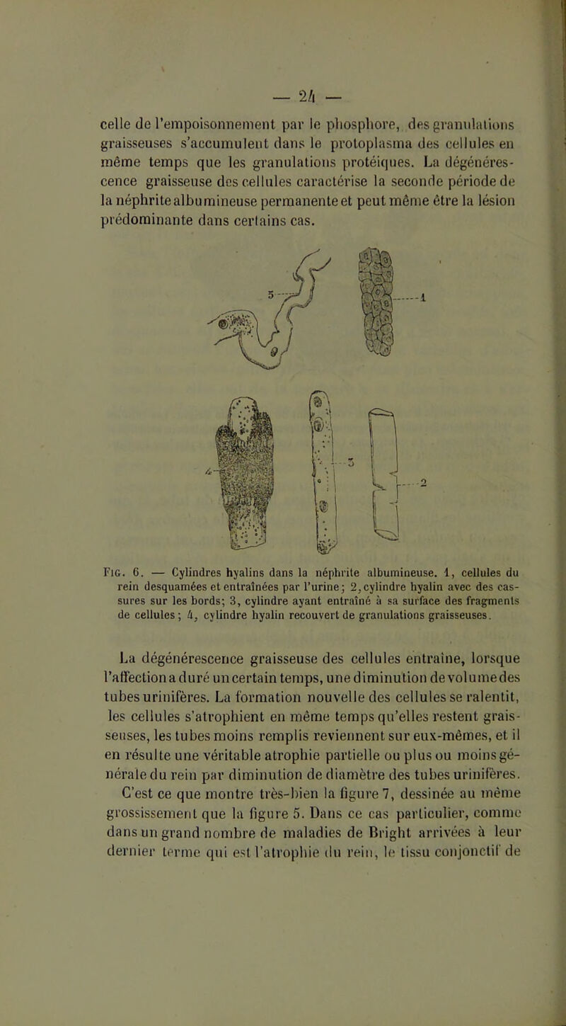 2/i — celle de l’empoisonnement par le phosphore, des granulations graisseuses s’accumulent dans le protoplasma des cellules en même temps que les granulations protéiques. La dégénéres- cence graisseuse des cellules caractérise la seconde période de la néphrite albumineuse permanente et peut même être la lésion prédominante dans certains cas. Fig. 6. — Cylindres hyalins dans la néphrite albumineuse. 1, cellules du rein desquamées et entraînées par l’urine; 2,cylindre hyalin avec des cas- sures sur les bords; 3, cylindre ayant entraîné à sa surface des fragments de cellules; U, cylindre hyalin recouvert de granulations graisseuses. La dégénérescence graisseuse des cellules entraîne, lorsque l’affection a duré uncertain temps, une diminution devolumedes tubes urinifères. La formation nouvelle des cellules se ralentit, les cellules s’atrophient en même temps qu’elles restent grais- seuses, les tubes moins remplis reviennent sur eux-mêmes, et il en résulte une véritable atrophie partielle ou plus ou moins gé- nérale du rein par diminution de diamètre des tubes urinifères. C’est ce que montre très-bien la figure 7, dessinée au même grossissement que la figure 5. Dans ce cas particulier, comme dans un grand nombre de maladies de Bright arrivées à leur dernier terme qui est l’atrophie du rein, le tissu conjonctif de