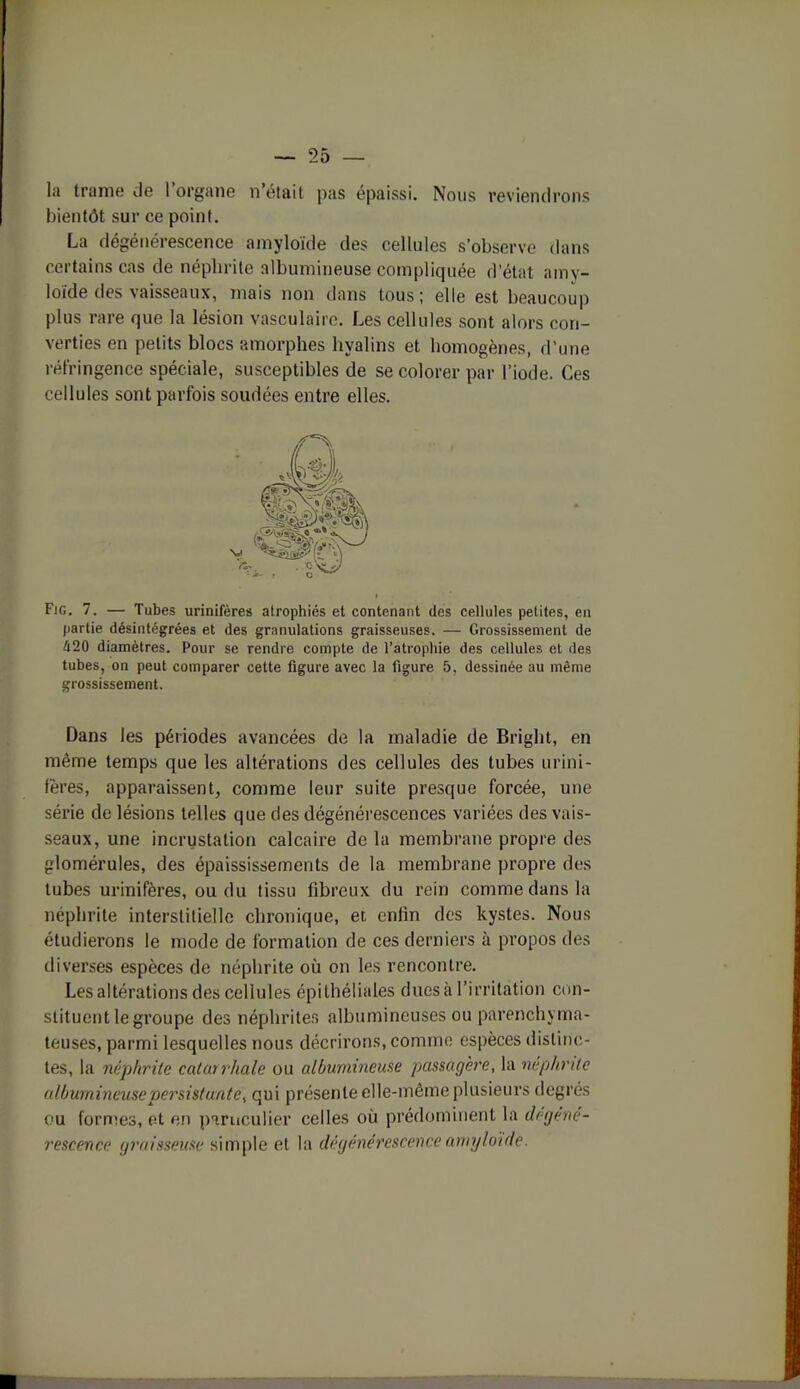 la trame Je 1 organe n était pas épaissi. Nous reviendrons bientôt sur ce point. La dégénérescence amyloïde des cellules s'observe dans certains cas de néphrite albumineuse compliquée d’état amv- loide des vaisseaux, mais non dans tous ; elle est beaucoup plus rare que la lésion vasculaire. Les cellules sont alors con- verties en petits blocs amorphes hyalins et homogènes, d’une réfringence spéciale, susceptibles de se colorer par l’iode. Ces cellules sont parfois soudées entre elles. Fjg. 7. — Tubes urinifères atrophiés et contenant des cellules petites, en partie désintégrées et des granulations graisseuses. — Grossissement de 420 diamètres. Pour se rendre compte de l’atrophie des cellules et des tubes, on peut comparer cette figure avec la figure 5, dessinée au même grossissement. Dans les périodes avancées de la maladie de Bright, en même temps que les altérations des cellules des tubes urini- fères, apparaissent, comme leur suite presque forcée, une série de lésions telles que des dégénérescences variées des vais- seaux, une incrustation calcaire delà membrane propre des glomérules, des épaississements de la membrane propre des tubes urinifères, ou du tissu fibreux du rein comme dans la néphrite interstitielle chronique, et enfin des kystes. Nous étudierons le mode de formation de ces derniers à propos des diverses espèces de néphrite où on les rencontre. Les altérations des cellules épithéliales dues à l’irritation con- stituent le groupe des néphrites albumineuses ou parenchyma- teuses, parmi lesquelles nous décrirons, comme espèces distinc- tes, la néphrite catarrhale ou albumineuse passagère, la néphrite albumineuse persistante, qui présente elle-même plusieurs degrés ou formes, et en particulier celles où prédominent la dégéné- rescence graisseuse simple et la dégénérescence amyloïde.