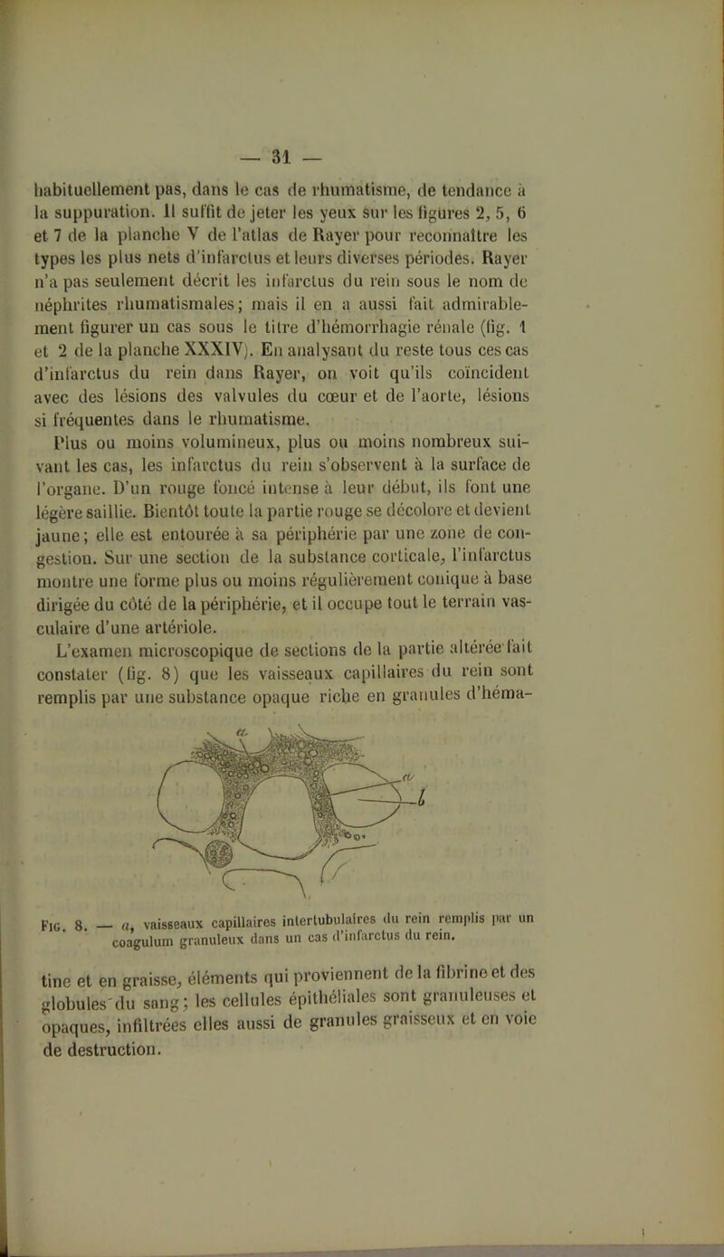 habituellement pas, dans le cas de rhumatisme, de tendance à la suppuration. 11 suffit de jeter les yeux sur les ligures 2, 5, 6 et 7 de la planche V de l’atlas de Rayer pour reconnaître les types les plus nets d’infarctus et leurs diverses périodes. Rayer n’a pas seulement décrit les infarctus du rein sous le nom de néphrites rhumatismales; mais il en a aussi fait admirable- ment figurer un cas sous le titre d’hémorrhagie rénale (tig. î et 2 de la planche XXXIV). Eu analysant du reste tous ces cas d’infarctus du rein dans Rayer, on voit qu’ils coïncident avec des lésions des valvules du cœur et de l’aorte, lésions si fréquentes dans le rhumatisme. i'ius ou moins volumineux, plus ou moins nombreux sui- vant les cas, les infarctus du rein s’observent à la surface de l’organe. D’un rouge foncé intense à leur début, ils font une légère saillie. Bientôt toute la partie rouge se décolore et devient jaune; elle est entourée a sa périphérie par une zone de con- gestion. Sur une section de la substance corticale, l’infarctus montre une forme plus ou moins régulièrement conique à base dirigée du côté de la périphérie, et il occupe tout le terrain vas- culaire d’une artériole. L’examen microscopique de sections de la partie altérée-fait constater (lig. 8) que les vaisseaux capillaires du rein sont remplis par une substance opaque riche en granules d’héma- Fig. 8. — a, vaisseaux capillaires intertubulaires <lu rein remplis par un coagulum granuleux dans un cas d’infarctus du rein. tine et en graisse, éléments qui proviennent de la fibrineet des globules'du sang; les cellules épithéliales sont granuleuses et opaques, infiltrées elles aussi de granules graisseux et en voie de destruction.