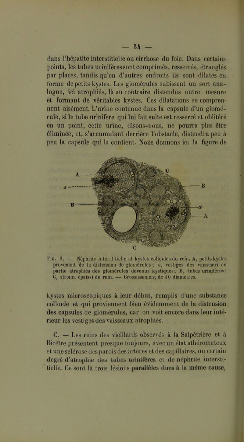 — 3 h — dans l’hépatite interstitielle ou cirrhose du l'oie. Dans certains points, les tubes urinifères sont comprimés, resserrés, étranglés par places, tandis qu’en d’autres endroits ils sont dilatés en forme de petits kystes. Les glomérules subissent un sort ana- logue, ici atrophiés, là au contraire distendus outre mesure et formant de véritables kystes. Ces dilatations se compren- nent aisément. L’urine contenue dans la capsule d’un glomé- rule, si le tube urinifère qui lui fait suite est resserré et oblitéré en un point, cette urine, disons-nous, ne pourra plus être éliminée, et, s’accumulant derrière l’obstacle, distendra peu à peu la capsule qui la contient. Nous donnons ici la figure de Fig. 9. — Néphrite interstitielle et kystes colloïdes du rein. A, petits kystes provenant de la distension de glomérules ; a, vestiges des vaisseaux en partie atrophiés des glomérules devenus kystiques; B, tubes urinifères; C, stroma épaissi du rein. — Grossissement de ÛO diamètres. kystes microscopiques à leur début, remplis d’utie substance colloïde et qui proviennent bien évidemment de la distension des capsules de glomérules, car on voit encore dans leur inté- rieur les vestiges des vaisseaux atrophiés. C. — Les reins des vieillards observés à la Salpêtrière et à Bicêtre présentent presque toujours, avec un état athéromateux et une sclérose des parois des artères et des capillaires, un certain degré d’atrophie des tubes urinifères et de néphrite intersti- tielle. Ce sont là trois lésions parallèles dues à la même cause,