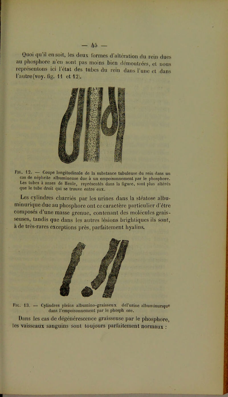Quoi qu il en soit, les deux tonnes d altération du rein ducs au phosphore n’en sont pas moins bien démontrées, et nous représentons ici l’état des tubes du rein dans l’une et dans l’autre(voy. lig. Il et 12). Fig. 12. — Coupe longitudinale de la substance tubuleuse du rein dans un cas de néphrite albumineuse due à un empoisonnement par le phosphore. Les tubes à anses de Henle, représentés dans la figure, sont plus altérés que le tube droit qui se trouve entre eux. Les cylindres charriés par les urines dans la stéatose albu- minurique due au phosphore ont ce caractère particulier d’être composés d’une masse grenue, contenant des molécules grais- seuses, tandis que dans les autres lésions brightiques ils sont, à de très-rares exceptions près, parfaitement hyalins. Fig. 13. — Cylindres pleins albumino-graisseux del’urinc albuminurique dans l’empoisonnement par le phosph ore. Dans les cas de dégénérescence graisseuse par le phosphore, les vaisseaux sanguins sont toujours parfaitement normaux :