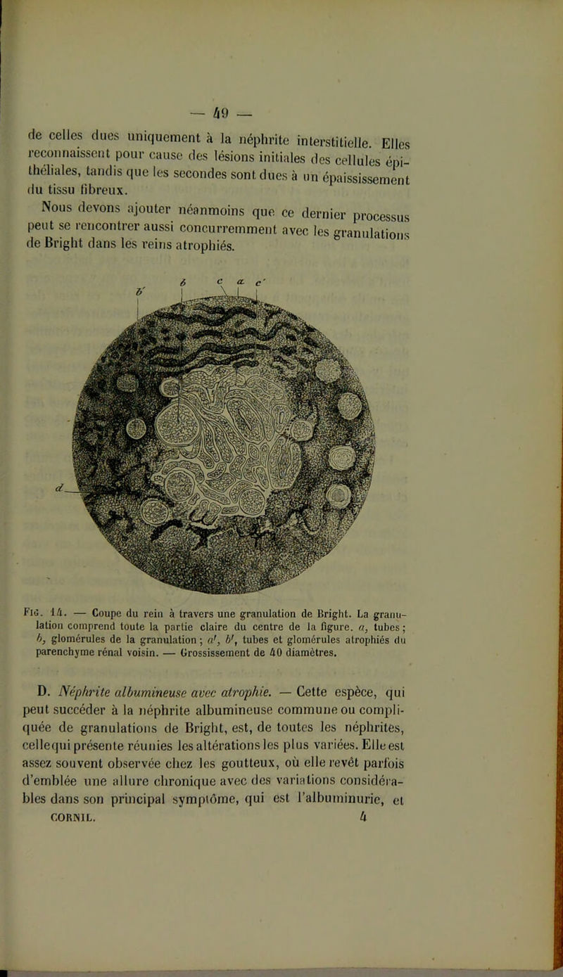 rie celles dues uniquement à la néphrite interstitielle. Elles reconnaissent pour cause des lésions initiales des cellules épi- théliales, tandis que les secondes sont dues à un épaississement du tissu fibreux. Nous devons ajouter néanmoins que ce dernier processus peut se rencontrer aussi concurremment avec les granulations de Bright dans les reins atrophiés. Fis. 1 4. — Coupe du rein à travers une granulation de Bright. La granu- lation comprend toute la partie claire du centre de la figure, a, tubes; b, glomérules de la granulation ; ab', tubes et glomérules atrophiés du parenchyme rénal voisin. — Grossissement de 40 diamètres. D. Néphrite albumineuse avec atrophie. — Cette espèce, qui peut succéder à la néphrite albumineuse commune ou compli- quée de granulations de Bright, est, de toutes les néphrites, eellcqui présente réunies les altérations les plus variées. Elle est assez souvent observée chez les goutteux, où elle revêt parfois d’emblée une allure chronique avec des variations considéra- bles dans son principal symptôme, qui est l’albuminurie, et cornil. h