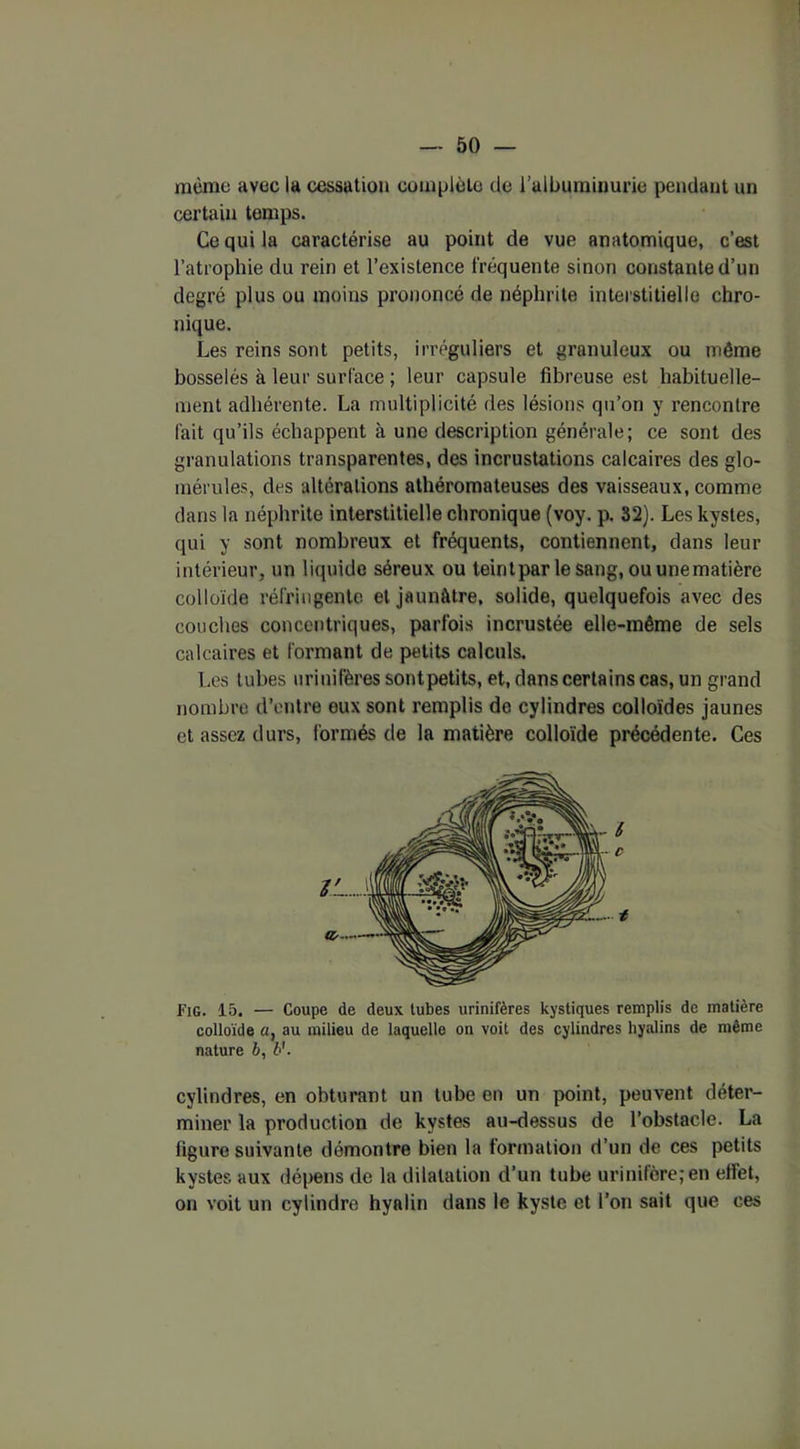 mémo avec la cessation complète de l’albuminurie pendant un certain temps. Ce qui la caractérise au point de vue anatomique, c’est l’atrophie du rein et l’existence fréquente sinon constante d’un degré plus ou moins prononcé de néphrite interstitielle chro- nique. Les reins sont petits, irréguliers et granuleux ou même bosselés à leur surface ; leur capsule fibreuse est habituelle- ment adhérente. La multiplicité des lésions qu’on y rencontre fait qu’ils échappent à une description générale; ce sont des granulations transparentes, des incrustations calcaires des glo- mérules, des altérations athéromateuses des vaisseaux, comme dans la néphrite interstitielle chronique (voy. p. 32). Les kystes, qui y sont nombreux et fréquents, contiennent, dans leur intérieur, un liquide séreux ou teintpar le sang, ou une matière colloïde réfringente et jaunâtre, solide, quelquefois avec des couches concentriques, parfois incrustée elle-même de sels calcaires et formant de petits calculs. Les tubes uriuifères sontpetits, et, dans certains cas, un grand nombre d’entre eux sont remplis de cylindres colloïdes jaunes et assez durs, formés de la matière colloïde précédente. Ces Fig. 15. — Coupe de deux tubes urinifères kystiques remplis de matière colloïde a, au milieu de laquelle on voit des cylindres hyalins de même nature b, b'. cylindres, en obturant un tube en un point, peuvent déter- miner la production de kystes au-dessus de l’obstacle. La figure suivante démontre bien la formation d’un de ces petits kystes aux dépens de la dilatation d’un tube urinifèrejen effet, on voit un cylindre hyalin dans le kyste et l’on sait que ces