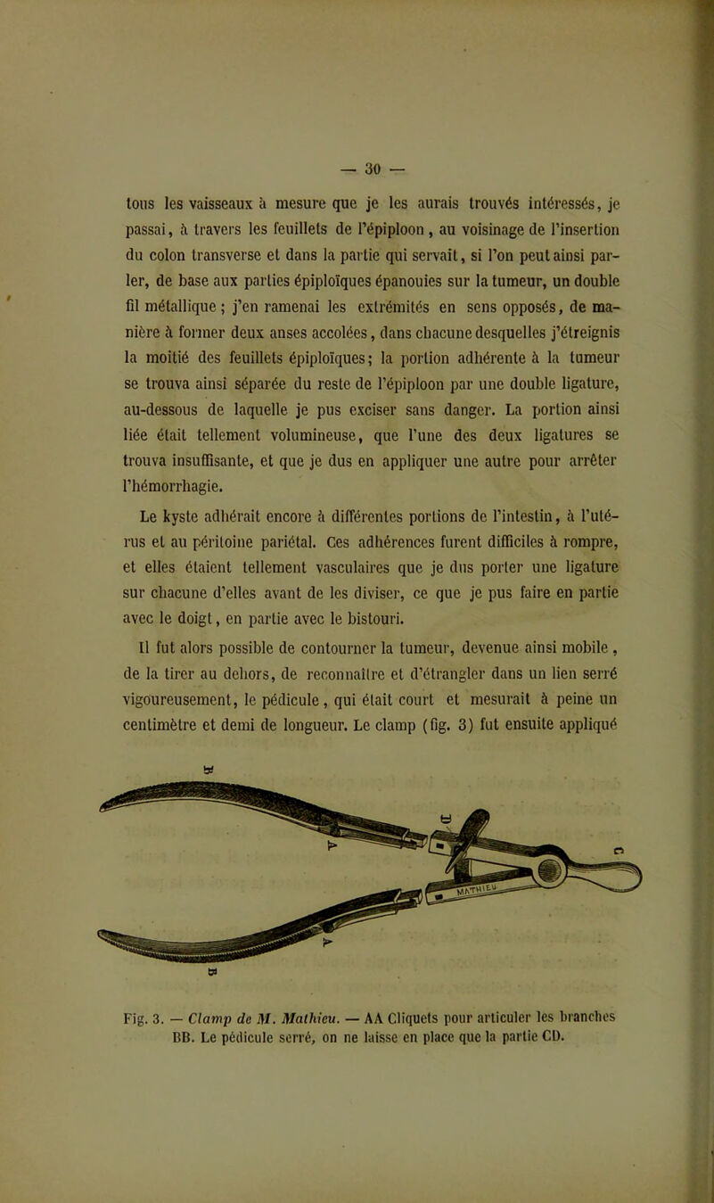 tous les vaisseaux à mesure que je les aurais trouvés intéressés, je passai, à travers les feuillets de l’épiploon, au voisinage de l’insertion du colon transverse et dans la pai tie qui servait, si l’on peut ainsi par- ler, de base aux parties épiploïques épanouies sur la tumeur, un double fil métallique; j’en ramenai les extrémités en sens opposés, de ma- nière à former deux anses accolées, dans chacune desquelles j’étreignis ta moitié des feuillets épiploïques ; la portion adhérente à la tumeur se trouva ainsi séparée du reste de l’épiploon par une double ligature, au-dessous de laquelle je pus exciser sans danger. La portion ainsi liée était tellement volumineuse, que l’une des deux ligatures se trouva insuffisante, et que je dus en appliquer une autre pour arrêter l’hémorrhagie. Le kyste adhérait encore à différentes portions de l’intestin, à l’uté- rus et au péritoine pariétal. Ces adhérences furent difficiles à rompre, et elles étaient tellement vasculaires que je dns porter une ligature sur chacune d’elles avant de les diviser, ce que je pus faire en partie avec le doigt, en partie avec le bistouri. Il fut alors possible de contourner la tumeur, devenue ainsi mobile, de la tirer au deliors, de reconnaître et d’étrangler dans un lien serré vigoureusement, le pédicule, qui était court et mesurait à peine un centimètre et demi de longueur. Le clamp (fig. 3) fut ensuite appliqué w b) Fig. 3. — Clamp de M. Mathieu. — AA Cliquets pour articuler les branches BB. Le pédicule serré, on ne laisse en place que la partie CD.