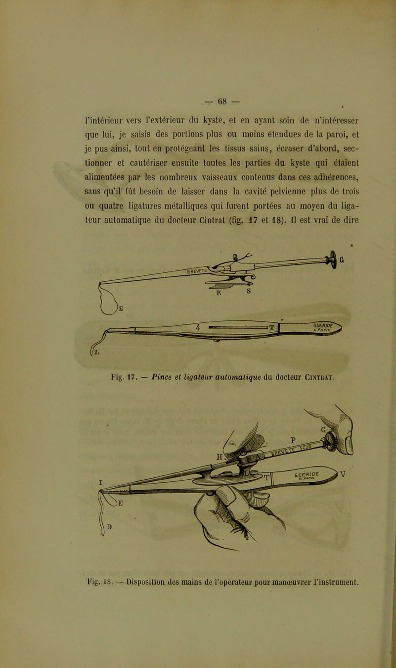 l’intérieiir vers l’extérieur du kyste, et en ayant soin de n’intéresser que lui, je saisis des portions plus ou moins étendues de la paroi, et je pus ainsi, tout en protégeant les tissus sains, écraser d’abord, sec- tionner et cautériser ensuite toutes les parties du kyste qui étaient alimentées par les nombreux vaisseaux contenus dans ces adhérences, sans qu’il fût besoin de laisser dans la cavité pelvienne plus de trois ou quatre ligatures métalliques qui furent portées au moyen du liga- teur automatique du docteur Cintrât (fig. 17 et 18). Il est vrai de dire Fig. 17. — Pince et ligateur automatique du docteur Cintrât. Fig. 18. — Disposition des mains de l’opérateur pour manœuvrer l’instrument.