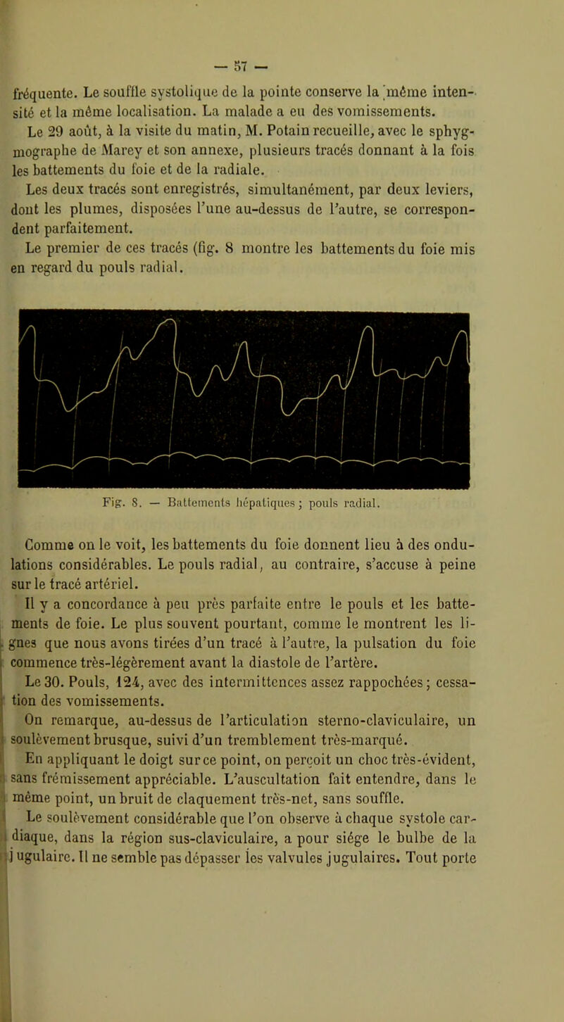 fréquente. Le souille systolique de la pointe conserve la 'même inten- sité et la même localisation. La malade a eu des vomissements. Le 29 août, à la visite du matin, M. Potain recueille, avec le sphyg- mographe de Marey et son annexe, plusieurs tracés donnant à la fois les battements du foie et de la radiale. Les deux tracés sont enregistrés, simultanément, par deux leviers, dont les plumes, disposées l’une au-dessus de l’autre, se correspon- dent parfaitement. Le premier de ces tracés (fig. 8 montre les battements du foie mis en regard du pouls radial. Fig. S. — Battements hépatiques; pouls radial. Comme on le voit, les battements du foie donnent lieu à des ondu- lations considérables. Le pouls radial, au contraire, s’accuse à peine sur le tracé artériel. Il y a concordance à peu près parfaite entre le pouls et les batte- ments de foie. Le plus souvent pourtant, comme le montrent les li- L gnes que nous avons tirées d’un tracé à l’autre, la pulsation du foie commence très-légèrement avant la diastole de l’artère. Le 30. Pouls, 124, avec des intermittences assez rappochées; cessa- tion des vomissements. On remarque, au-dessus de l’articulation sterno-claviculaire, un soulèvement brusque, suivi d’un tremblement très-marqué. En appliquant le doigt surce point, on perçoit un choc très-évident, sans frémissement appréciable. L’auscultation fait entendre, dans le même point, un bruit de claquement très-net, sans souffle. Le soulèvement considérable que l’on observe à chaque systole car- diaque, dans la région sus-claviculaire, a pour siège le bulbe de la j ugulairc. Il ne semble pas dépasser les valvules jugulaires. Tout porte