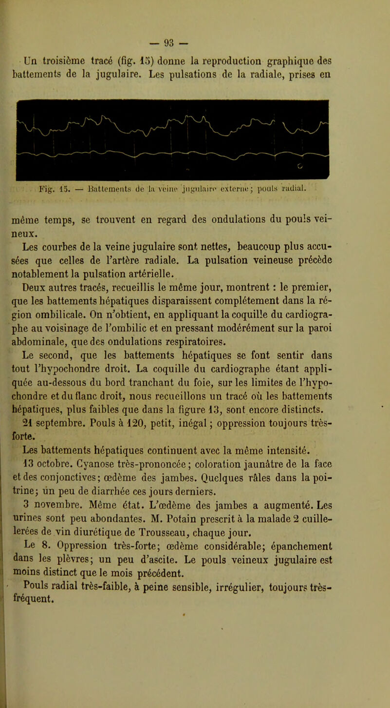 Un troisième tracé (fig. 15) donne la reproduction graphique des battements de la jugulaire. Les pulsations de la radiale, prises en même temps, se trouvent en regard des ondulations du pouls vei- neux. Les courbes de la veine jugulaire sont nettes, beaucoup plus accu- sées que celles de l’artère radiale. La pulsation veineuse précède notablement la pulsation artérielle. Deux autres tracés, recueillis le même jour, montrent : le premier, que les battements hépatiques disparaissent complètement dans la ré- gion ombilicale. On n’obtient, en appliquant la coquille du cardiogra- phe au voisinage de l’ombilic et en pressant modérément sur la paroi abdominale, que des ondulations respiratoires. Le second, que les battements hépatiques se font sentir dans tout l’hvpochondre droit. La coquille du cardiographe étant appli- quée au-dessous du bord tranchant du foie, sur les limites de l’hypo- chondre et du flanc droit, nous recueillons un tracé où les battements hépatiques, plus faibles que dans la ligure 13, sont encore distincts. 21 septembre. Pouls à 120, petit, inégal ; oppression toujours très- forte. Les battements hépatiques continuent avec la même intensité. 13 octobre. Cyanose très-prononcée; coloration jaunâtre de la face et des conjonctives; œdème des jambes. Quelques râles dans la poi- trine; un peu de diarrhée ces jours derniers. 3 novembre. Même état. L’œdème des jambes a augmenté. Les urines sont peu abondantes. M. Potain prescrit à la malade 2 cuille- lerées de vin diurétique de Trousseau, chaque jour. Le 8. Oppression très-forte; œdème considérable; épanchement dans les plèvres; un peu d’ascite. Le pouls veineux jugulaire est moins distinct que le mois précédent. Pouls radial très-faible, à peine sensible, irrégulier, toujours très- fréquent.