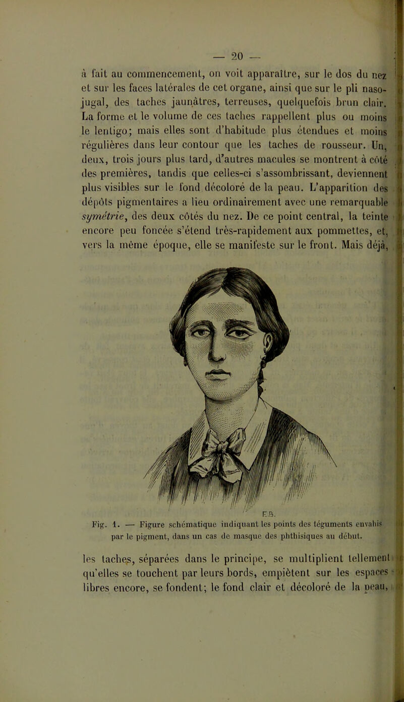 à l'ail au conimencemenl, ou voit apparaître, sur le dos du nez * et sur les faces latérales de cet organe, ainsi que sur le pli naso- jugal, des taches jaunâtres, terreuses, quelquefois brun clair. ■ La forme et le volume de ces taches rappellent plus ou moins ; le lenligo; mais elles sont d’habitude plus étendues et moins ! régulières dans leur contour que les taches de rousseur. Un, deux, trois jours plus tard, d’autres macules se montrent à côté des premières, tandis que celles-ci s’assombrissant, deviennent plus visibles sur le fond décoloré de la peau. L’apparition des dépôts pigmentaires a lieu ordinairement avec une remarquable symétrie, des deux côtés du nez. De ce point central, la teinte , encore peu foncée s’étend très-rapidement aux pommettes, et, vers la même époque, elle se manifeste sur le front. Mais déjà, i F..R. f Fig. 1. — Figure schématique indiquant les points des téguments envahis di par le pigment, dans un cas de masque des phthisiques au début. j les tacbe^, séparées dans le principe, se multiplient tellement qu’elles se touchent par leurs bords, empiètent sur les espaces - ^ libres encore, se fondent; le fond clair et décoloré de la peau,