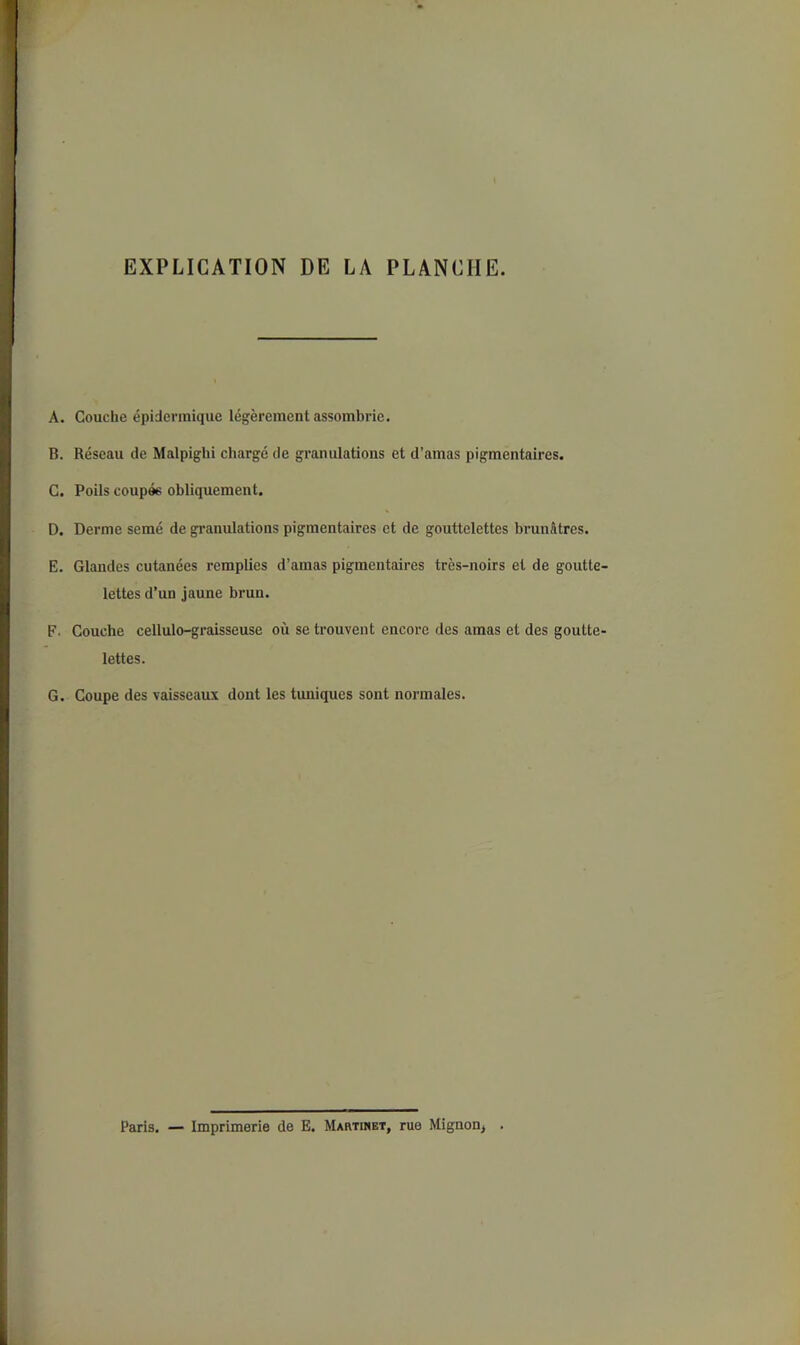 EXPLICATION DE LA PLANCHE. A. Couche épidermique légèrement assombrie. B. Réseau de Malpigbi chargé de granulations et d’amas pigmentaires. C. Poils coupée obliquement. D. Derme semé de granulations pigmentaires et de gouttelettes brunâtres. E. Glandes cutanées remplies d’amas pigmentaires très-noirs et de goutte lettes d’un jaune brun. F. Couche cellulo-graisseuse où se trouvent encore des amas et des goutte lettes. G. Coupe des vaisseaux dont les tuniques sont normales. Paris. — Imprimerie de E. Martinet, rue Mignon, .