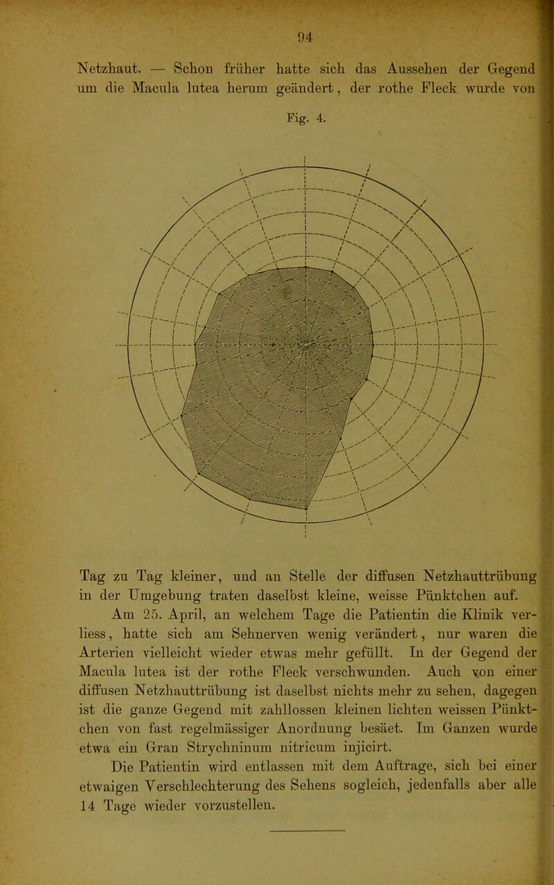 Netzhaut. — Schou früher hatte sich das Aussehen der Gegend um die Macula lutea herum geändert, der rothe Fleck wurde von Fig. 4. Tag zu Tag kleiner, und an Stelle der diJßPusen Netzhauttrübung in der Umgebung traten daselbst kleine, weisse Pünktchen auf. Am 25. April, an welchem Tage die Patientin die Klinik ver- liess, hatte sich am Sehnerven wenig verändert, nur waren die ', Artei'ien vielleicht wieder etwas mehr gefüllt. In der Gegend der Macula lutea ist der rothe Fleck verschwunden. Auch von einer diffusen Netzhauttrübung ist daselbst nichts mehr zu sehen, dagegen ist die ganze Gegend mit zahllossen kleinen lichten weissen Pünkt- chen von fast regelmässiger Anordnung besäet. Im Ganzen wurde •• etwa ein Gran Strychninum nitricum injicirt. Die Patientin wird entlassen mit dem Aufträge, sich bei einer etwaigen Verschlechterung des Sehens sogleich, jedenfalls aber alle . 14 Tage wieder vorzustellen.