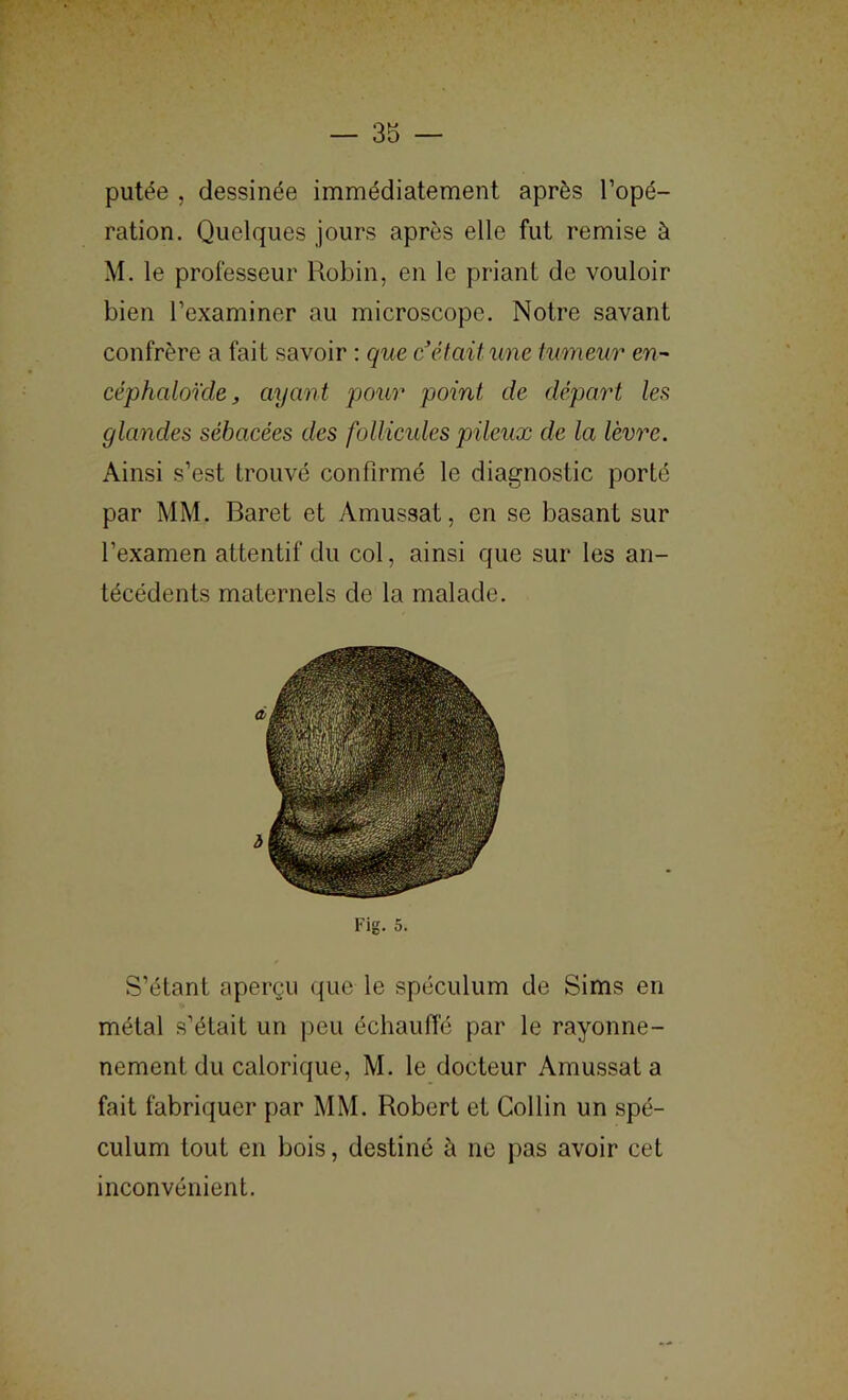putée , dessinée immédiatement après l’opé- ration. Quelques jours après elle fut remise à M. le professeur Uobin, en le priant de vouloir bien l’examiner au microscope. Notre savant confrère a fait savoir ; que c'était une tumeur en- céphaloüle, ayant pour point de départ les glandes sébacées des follicules pileux de la lèvre. Ainsi s’est trouvé confirmé le diagnostic porté par MM. Baret et Amussat, en se basant sur l’examen attentif du col, ainsi que sur les an- técédents maternels de la malade. Fig. 5. S’étant aperçu que le spéculum de Sims en métal s’était un peu échaufi'é par le rayonne- nement du calorique, M. le docteur Amussat a fait fabriquer par MM. Robert et Collin un spé- culum tout en bois, destiné à ne pas avoir cet inconvénient.
