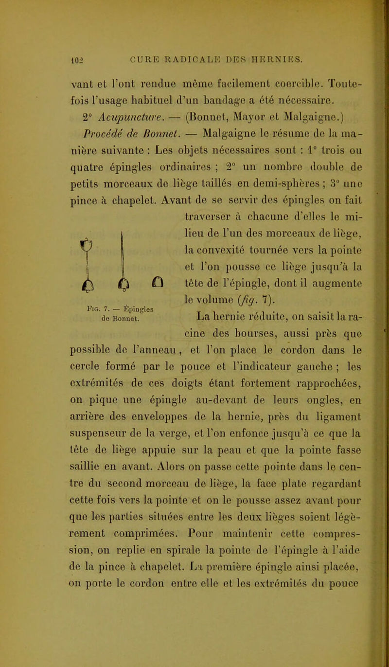 vant cl l’ont rendue môme facilement coerciblo. Toute- fois l’usage habituel d’un bandage a été nécessaire. 2° Acupuncture. — (Bonnet, Mayor et Malgaignc.) Procédé de Bonnet. — Malgaigne le résume de la ma- nière suivanto : Les objets nécessaires sont : 1° trois ou quatre épingles ordinaires ; 2° un nombre double de petits morceaux de liège taillés en demi-sphères ; 3° une pince à chapelet. Avant de se servir des épingles on fait traverser à chacune d’elles le mi- lieu de l’un des morceaux de liège, la convexité tournée vers la pointe et l’on pousse ce liège jusqu'à la tête de l’épingle, dont il augmente le volume (fig. 7). La hernie réduite, on saisit la ra- cine des bourses, aussi près que possible de l’anneau, et l’on place le cordon dans le cercle formé par le pouce et l’indicateur gauche ; les extrémités de ces doigts étant fortement rapprochées, on pique une épingle au-devant de leurs ongles, en arrière des enveloppes de la hernie, près du ligament suspenseur de la verge, et l’on enfonce jusqu’à ce que la tête de liège appuie sur la peau et que la pointe fasse saillie en avant. Alors on passe celte pointe dans le cen- tre du second morceau de liège, la face plate regardant cette fois vers la pointe et on le pousse assez avant pour que les parties situées outre les deux lièges soient légè- rement comprimées. Pour maintenir cette compres- sion, on replie en spirale la pointe de l’épingle à l’aide de la pince à chapelet. La première épinglo ainsi placée, on porte le cordon entre elle et les extrémités du pouce Fig. 7. — Épingles de Bonnet.