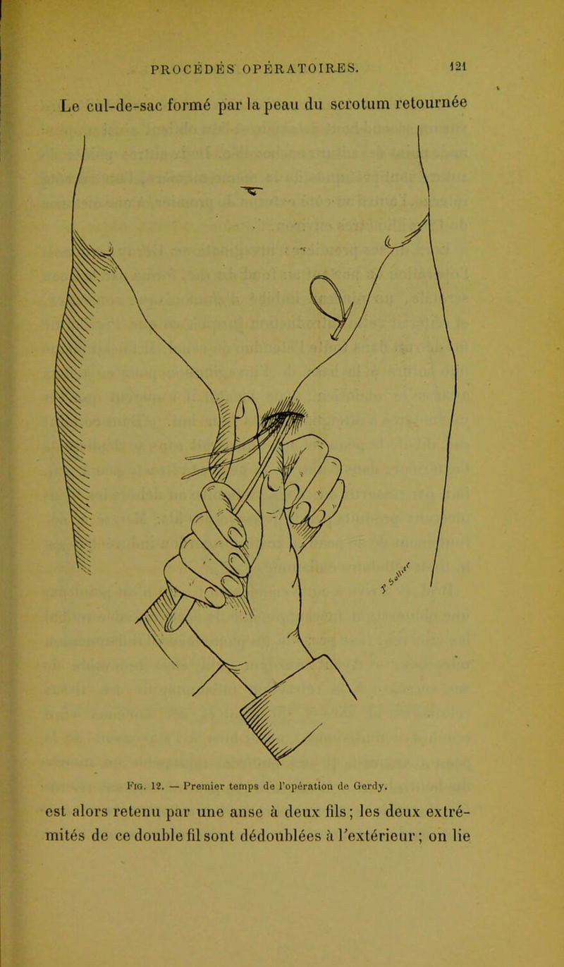 Le cul-de-sac formé par la peau du scrotum retournée Fia. 12. — Premier temps de l’opération de Gerdy. est alors retenu par une anse à deux fils; les deux extré- mités de ce double fil sont dédoublées à l'extérieur; on lie