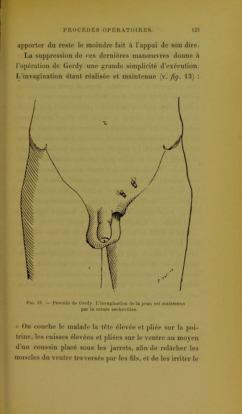 apporter du reste le moindre fait à l’appui de son dire. La suppression de ces dernières manœuvres donne à l’opération de Gerdy une grande simplicité d’exécution. L’invagination étant réalisée et maintenue (v. fig. 13) : Fig. 13. — Procédé de Gerdy. L’invagination de la peau est maintenue par la suture enchevillée. « On couche le malade la tête élevée et pliée sur la poi- trine, les cuisses élevées et pliées sur le ventre au moyen d’un coussin placé sous les jarrets, afin de relâcher les muscles du ventre traversés par les fils, et de les irriter le