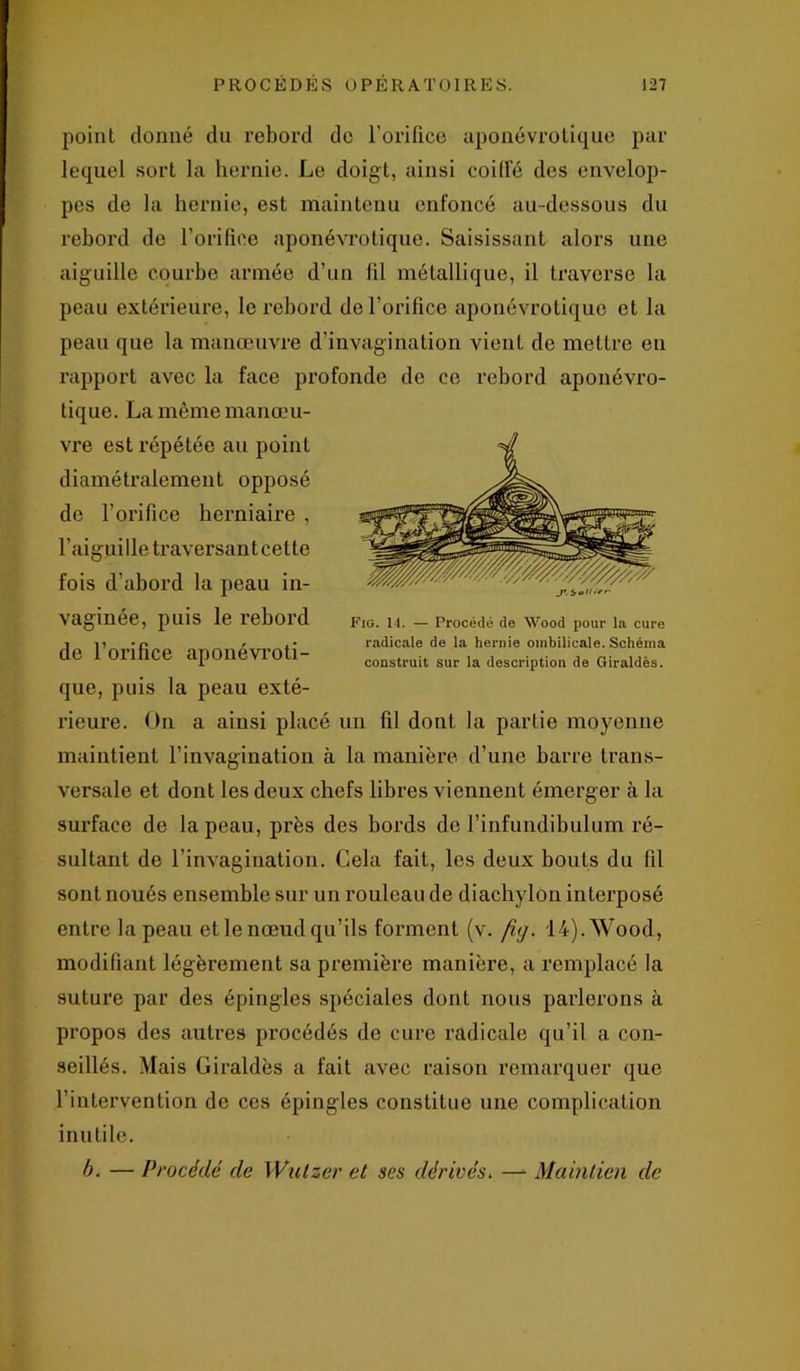 point donné du rebord de l’orifice aponévrotique par lequel sort la hernie. Le doigt, ainsi coiffé des envelop- pes de la hernie, est maintenu enfoncé au-dessous du rebord de l’orifice aponévrotique. Saisissant alors une aiguille courbe armée d’un fil métallique, il traverse la peau extérieure, le rebord de l'orifice aponévrotique et la peau que la manœuvre d’invagination vient de mettre en rapport avec la face profonde de ce rebord aponévro- tique. La même manœu- que, puis la peau exté- rieure. On a ainsi placé un fil dont la partie moyenne maintient l’invagination à la manière d’une barre trans- versale et dont les deux chefs libres viennent émerger à la surface de la peau, près des bords de l’infundibulum ré- sultant de l’invagination. Cela fait, les deux bouts du fil sont noués ensemble sur un rouleau de diachylon interposé entre la peau et le nœud qu’ils forment (v. fuj. 14).\Vood, modifiant légèrement sa première manière, a remplacé la suture par des épingles spéciales dont nous parlerons à propos des autres procédés de cure radicale qu’il a con- seillés. Mais Giraldès a fait avec raison remarquer que l’intervention de ces épingles constitue une complication inu tile. b. — Procédé de Wutzer et ses dérivés. — Maintien de vre est répétée au point diamétralement opposé de l’orifice herniaire , l'aiguille traversanteette fois d’abord la peau in- vaginée, puis le rebord de l’orifice aponévroti- Fig. 14. — Procédé de Wood pour la cure radicale de la hernie ombilicale. Schéma construit sur la description de Giraldès.