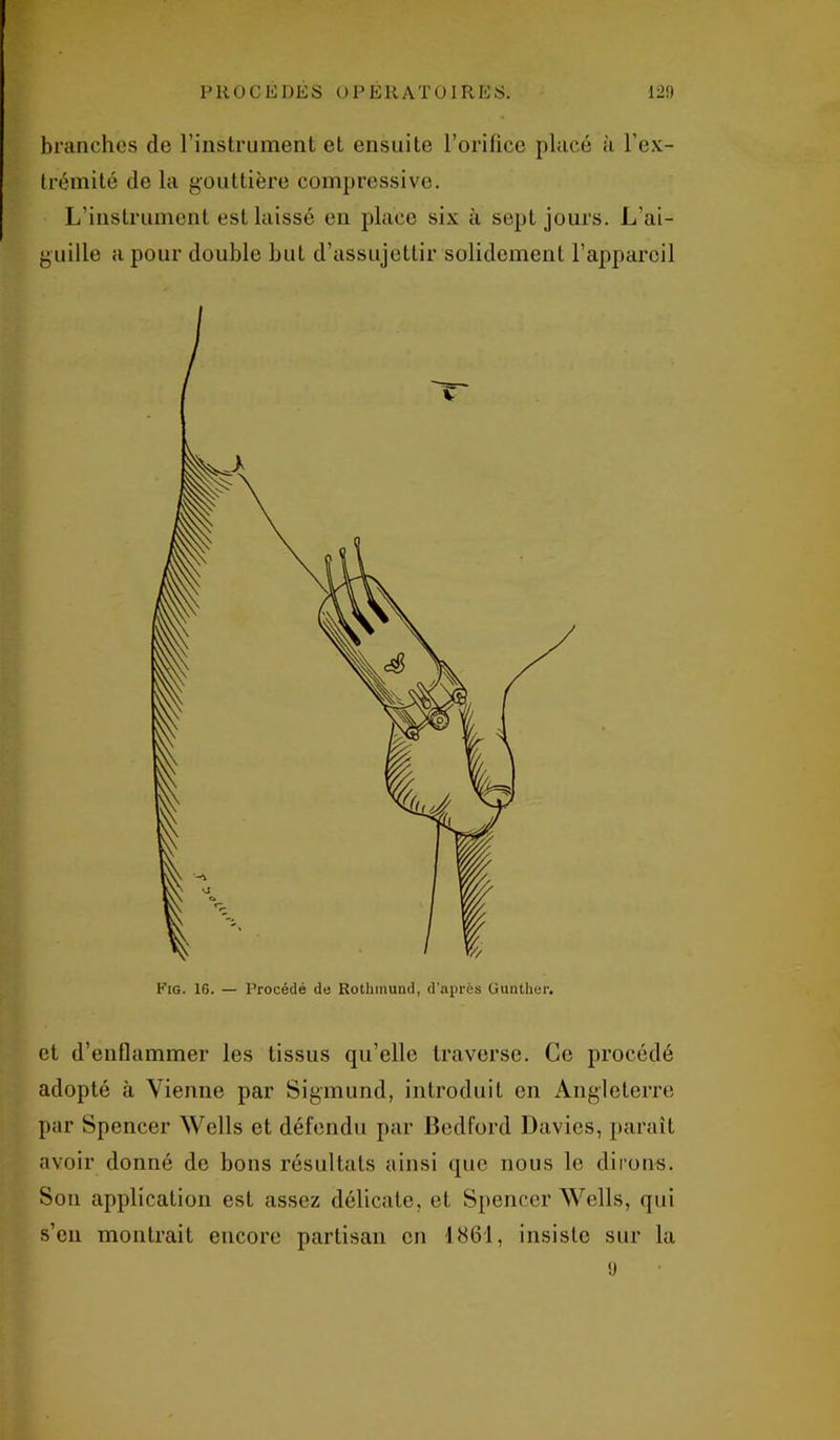 branches de l’instrument et ensuite l’orifice placé à l’ex- trémité de la gouttière compressive. L’instrument est laissé en place six à sept jours. L’ai- guille a pour double but d’assujettir solidement l’appareil et d’enflammer les tissus qu’elle traverse. Ce procédé adopté à Vienne par Sigmund, introduit en Angleterre par Spencer Wells et défendu par Bedford Davies, paraît avoir donné de bons résultats ainsi que nous le dirons. Son application est assez délicate, et Spencer Wells, qui s’en montrait encore partisan en 1861, insiste sur la 9