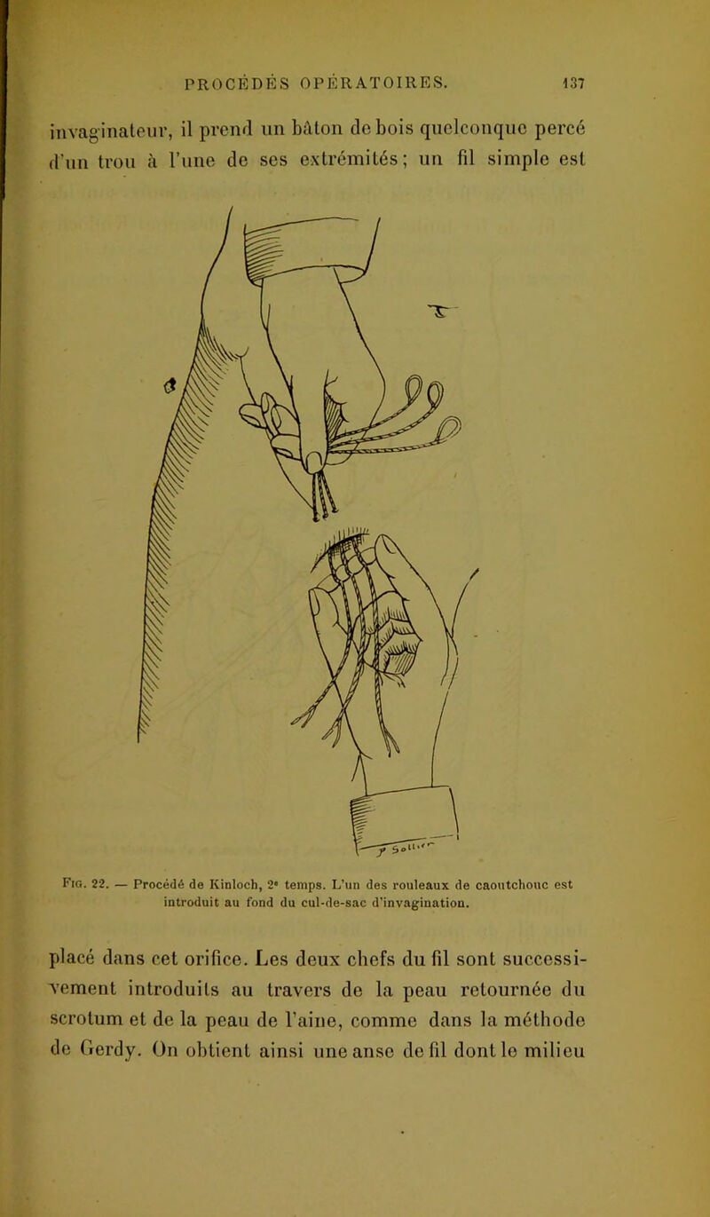 invaginateur, il prend un bâton do bois quelconque percé d'un trou à l’une de ses extrémités; un fil simple est Fig. 22. — Procédé de Kinloch, 2e temps. L’un des rouleaux de caoutchouc est introduit au fond du cul-de-sac d’invagination. placé dans cet orifice. Les deux chefs du fil sont successi- vement introduits au travers de la peau retournée du scrotum et de la peau de l’aine, comme dans la méthode de Gerdy. On obtient ainsi une anse de fil dont le milieu