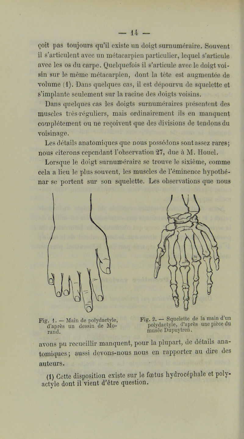 çoit pas toujours qu’il existe un doigt surnuméraire. Souvent il s’articulent avec un métacarpien particulier, lequel s’articule avec les os du carpe. Quelquefois il s’articule avec le doigt voi- sin sur le même métacarpien, dont la tête est augmentée de volume (1). Dans quelques cas, il est dépourvu de squelette et s’implante seulement sur la racine des doigts voisins. Dans quelques cas les doigts surnuméraires présentent des muscles très-réguliers, mais ordinairement ils en manquent complètement ou ne reçoivent que des divisions de tendons du voisinage. Les détails anatomiques que nous possédons sont assez rares; nous citerons cependant l’observation 27, due à M. Ilouel. Lorsque le doigt surnuméraire se trouve le sixième, comme cela a lieu le plus souvent, les muscles de l’éminence hypothé- nar se portent sur son squelette. Les observations que nous avons pu recueillir manquent, pour la plupart, de détails ana- tomiques ; aussi devons-nous nous en rapporter au dire des auteurs. (1) Cette disposition existe sur le fœtus hydrocéphale et poly- actyle dont il vient d’être question. Fig. 1. — Main de polydactyle, d’après un dessin de Mo- rand. Fig. 2. — Squelette de la main d un polydactyle, d’après une pièce du musée Dupuytren. — Squelette de la main d’un