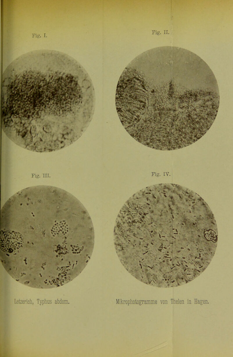 Fig. I Fig. II. i Fig. IV. Lelzepieh, Typhus ahdom. Mikpopliotogramme von Thelen in Hagen.