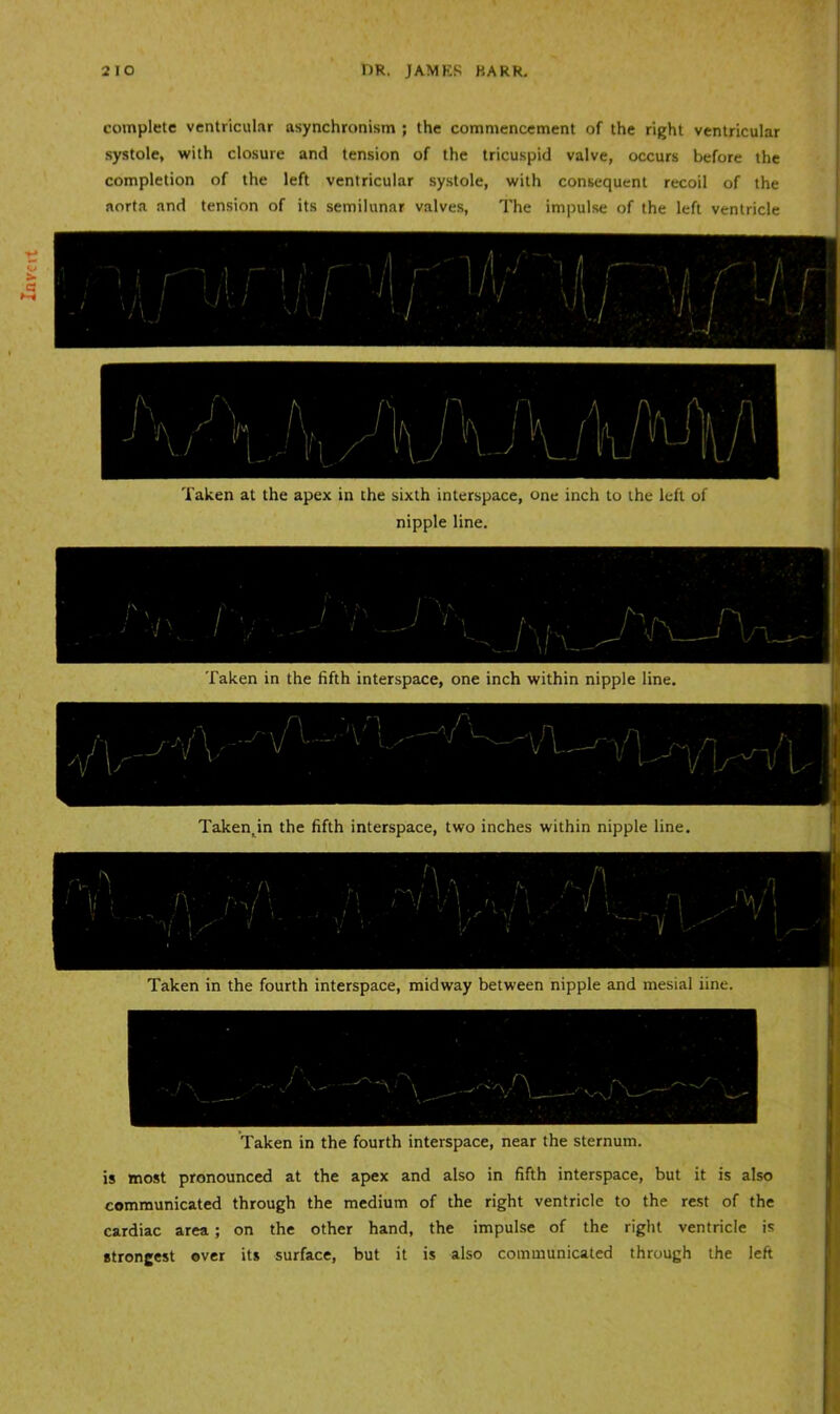 complete ventricular asynchronism ; the commencement of the right ventricular systole, with closure and tension of the tricuspid valve, occurs before the completion of the left ventricular systole, with consequent recoil of the aorta and tension of its semilunar valves, The impulse of the left ventricle Taken at the apex in the sixth interspace, one inch to the left of nipple line. Taken in the fifth interspace, one inch within nipple line. Taken in the fourth interspace, midway between nipple and mesial iine. Taken in the fourth interspace, near the sternum. is most pronounced at the apex and also in fifth interspace, but it is also communicated through the medium of the right ventricle to the rest of the cardiac area; on the other hand, the impulse of the right ventricle is strongest over its surface, but it is also communicated through the left