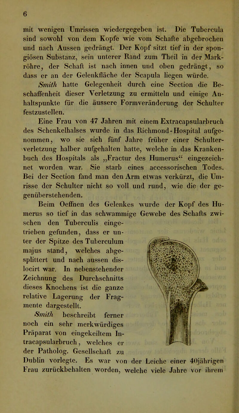 mit wenigen Umrissen wiedergegeben ist. Die Tubercula sind sowohl von dem Kopfe wie vom Schafte abgebrochen und nach Aussen gedrängt. Der Kopf sitzt tief in der spon- giösen Substanz, sein unterer Rand zum Theil in der Mark- röhre, der Schaft ist nach innen und oben gedrängt, so dass er an der Gelenkfläche der Scapula liegen würde. Smith hatte Gelegenheit durch eine Section die Be- schaffenheit dieser Verletzung zu ermitteln und einige An- haltspunkte für die äussere Formveränderung der Schulter festzustellen. Eine Frau von 47 Jahren mit einem Extracapsularbruch des Schenkelhalses wurde in das Richmond-Hospital aufge- nommen, wo sie sich fünf Jahre früher einer Schulter- verletzung halber aufgehalten hatte, welche in das Kranken- buch des Hospitals als „Fractur des Humerus“ eingezeich- net worden war. Sie starb eines accessorischen Todes. Bei der Section fand man den Arm etwas verkürzt, die Um- risse der Schulter nicht so voll und rund, wie die der ge- genüberstehenden. Beim Oeffnen des Gelenkes wurde der Kopf des Hu- merus so tief in das schwammige Gewebe des Schafts zwi- schen den Tuberculis einge- trieben gefunden, dass er un- ter der Spitze des Tuberculum majus stand, welches abge- splittert und nach aussen dis- locirt war. In nebenstehender Zeichnung des Durchschnitts dieses Knochens ist die ganze relative Lagerung der Frag- mente dargestellt. Smith beschreibt ferner noch ein sehr merkwürdiges Präparat von eingekeiltem In- tracapsularbruch, welches er der Patholog. Gesellschaft zu Dublin vorlegte. Es war von der Leiche einer 40jährigcn Frau zurückbehalten worden, welche viele Jahre vor ihrem