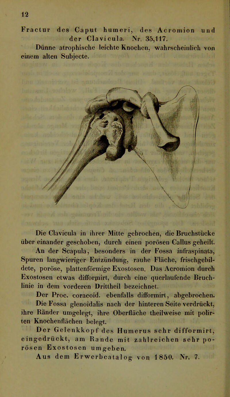 Fractur des Caput huineri, des Acromion und der Clavicula. Nr. 35,117. Dünne atrophische leichte Knochen, wahrscheinlich von einem alten Subjecte. Die Clavicula in ihrer Mitte gebrochen, die Bruchstücke über einander geschoben, durch einen porösen Callus geheilt. An der Scapula, besonders in der Fossa infraspinata, Spuren langwieriger Entzündung, rauhe Fläche, frischgebil- dete, poröse, plattenförmige Exostosen. Das Acromion durch Exostosen etwas düForpiirt, durch eine querlaufende Bruch- linie in dem vorderen Drittheil bezeichnet. Der Proc. coracoid. ebenfalls diflFormirt, abgebrochen. Die Fossa glenoidalis nach der hinteren Seite verdrückt, ihre Ränder umgelegt, ihre Oberfläche theilweise mit polir- ten Knochenflächen belegt. Der Gelenkkopf des Humerus sehr difformirt, eingedrückt, am Rande mit zahlreichen sehr po- rösen Exostosen umgeben. Aus dem Erwerbcatalog von 1850. Nr, 7.