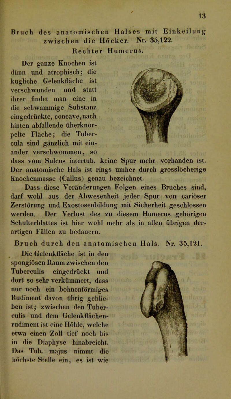 Bruch des anatomischen Halses mit Einkeilung zwischen die Höcker. Nr. 35,122. Rechter Humerus. Der ganze Knochen ist dünn und atrophisch; die kugliche Geleiikfläche ist verschwunden und statt ihrer findet man eine in die schwammige Substanz eingedrückte, concave, nach hinten abfallende überknor- pelte Fläche; die Tuber- cula sind gänzlich mit ein- ander verschwommen, so dass vom Sulcus intertub. keine Spur mehr vorhanden ist. Der anatomische Hals ist rings umher durch grosslöcherige Knochenmasse (Gallus) genau bezeichnet. Dass diese Veränderungen Folgen eines Bruches sind, darf wohl aus der Abwesenheit jeder Spur von cariöser Zerstörung und Exostosenbildung mit Sicherheit geschlossen werden. Der Verlust des zu diesem Humerus gehörigen Schulterblattes ist hier wohl mehr als in allen übrigen der- artigen Fällen zu bedauern. Bruch durch den anatomischen Hals. Nr. 35,121, Die Gelenkfläche ist in den spongiösen Raum zwischen den Tuberculis eingedrückt und dort so sehr verkümmert, dass nur noch ein bohnenförmiges Rudiment davon übrig geblie- ben ist; zwischen den Tuber- culis und dem Gelenkflächen- rudiment ist eine Höhle, welche etwa einen Zoll tief noch bis in die Diaphyse hinabreicht. Das Tub. majus nimmt die höchste Stelle ein, es ist wie