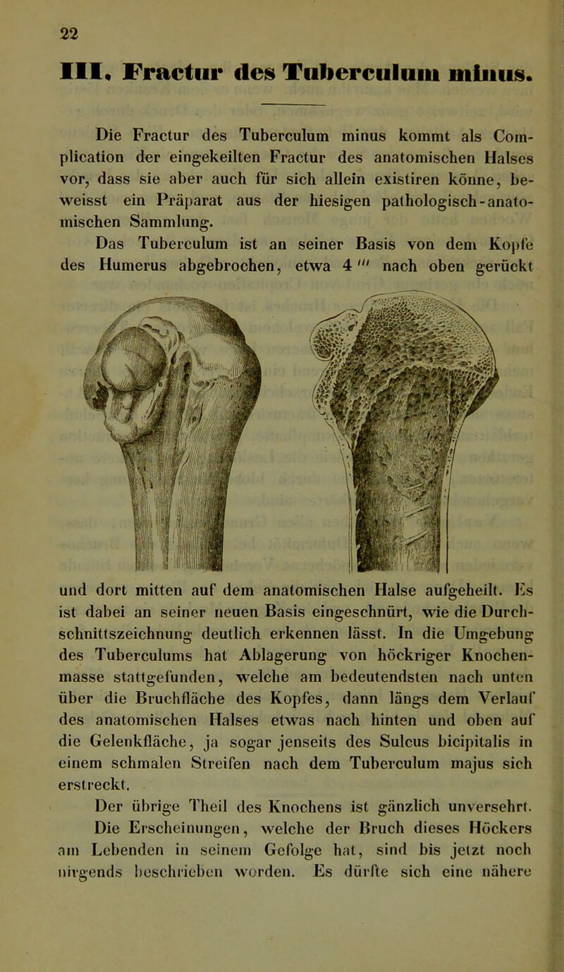 111« Fractiir deis Tulierculuiu minus. Die Fraclur des Tuberculum minus kommt als Com- plicalion der eingekeilten Fractur des anatomischen Halses vor, dass sie aber auch für sich allein existiren könne, be- weisst ein Präj)arat aus der hiesigen pathologisch-anato- mischen Sammlung. Das Tuberculum ist an seiner Basis von dem Kopfe des Humerus abgebrochen, etwa 4' nach oben gerückt und dort mitten auf dem anatomischen Halse aufgeheilt. Es ist dabei an seiner neuen Basis eingeschnürt, wie die Durch- schnittszeichnung deutlich erkennen lässt. In die Umgebung des Tuberculums hat Ablagerung von höckriger Knochen- masse stattgefunden, welche am bedeutendsten nach unten über die Bruchfläche des Kopfes, dann längs dem Verlauf des anatomischen Halses etwas nach hinten und oben auf die Gelenkfläche, ja sogar jenseits des Sulcus bicipitalis in einem schmalen Streifen nach dem Tuberculum majus sich ersti’eckt. Der übrige Theil des Knochens ist gänzlich unversehrt. Die Erscheinungen, welche der Bruch dieses Höckers am Lebenden in seinem Gefolge hat, sind bis jetzt noch nirgend.s beschrieben worden. Es dürfte sich eine nähere
