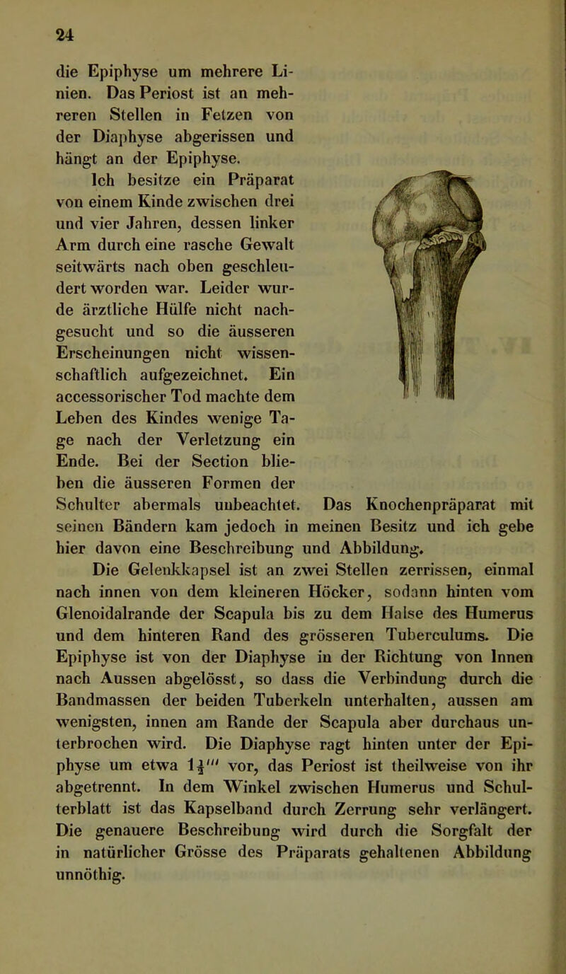 die Epiphyse um mehrere Li- nien. Das Periost ist an meh- reren Stellen in Fetzen von der Diaphyse abgerissen und hängt an der Epiphyse. Ich besitze ein Präparat von einem Kinde zwischen drei und vier Jahren, dessen linker Arm durch eine rasche Gewalt seitwärts nach oben geschleu- dertworden war. Leider wur- de ärztliche Hülfe nicht nach- gesucht und so die äusseren Erscheinungen nicht wissen- schaftlich aufgezeichnet. Ein accessorischer Tod machte dem Leben des Kindes wenige Ta- ge nach der Verletzung ein Ende. Bei der Section blie- ben die äusseren Formen der Schulter abermals unbeachtet. Das Knochenpräparat mit seinen Bändern kam jedoch in meinen Besitz und ich gebe hier davon eine Beschreibung und Abbildung, Die Gelenkkapsel ist an zwei Stellen zerrissen, einmal nach innen von dem kleineren Höcker, sodann hinten vom Glenoidalrande der Scapula bis zu dem Halse des Humerus und dem hinteren Rand des grösseren Tuberculums. Die Epiphyse ist von der Diaphyse in der Richtung von Innen nach Aussen abgelösst, so dass die Verbindung durch die Bandmassen der beiden Tuberkeln unterhalten, aussen am wenigsten, innen am Rande der Scapula aber durchaus un- terbrochen wird. Die Diaphyse ragt hinten unter der Epi- physe um etwa 1^' vor, das Periost ist theilweise von ihr abgetrennt. In dem Winkel zwischen Humerus und Schul- terblatt ist das Kapselband durch Zerrung sehr verlängert. Die genauere Beschreibung wird durch die Sorgfalt der in natürlicher Grösse des Präparats gehaltenen Abbildung unnöthig.