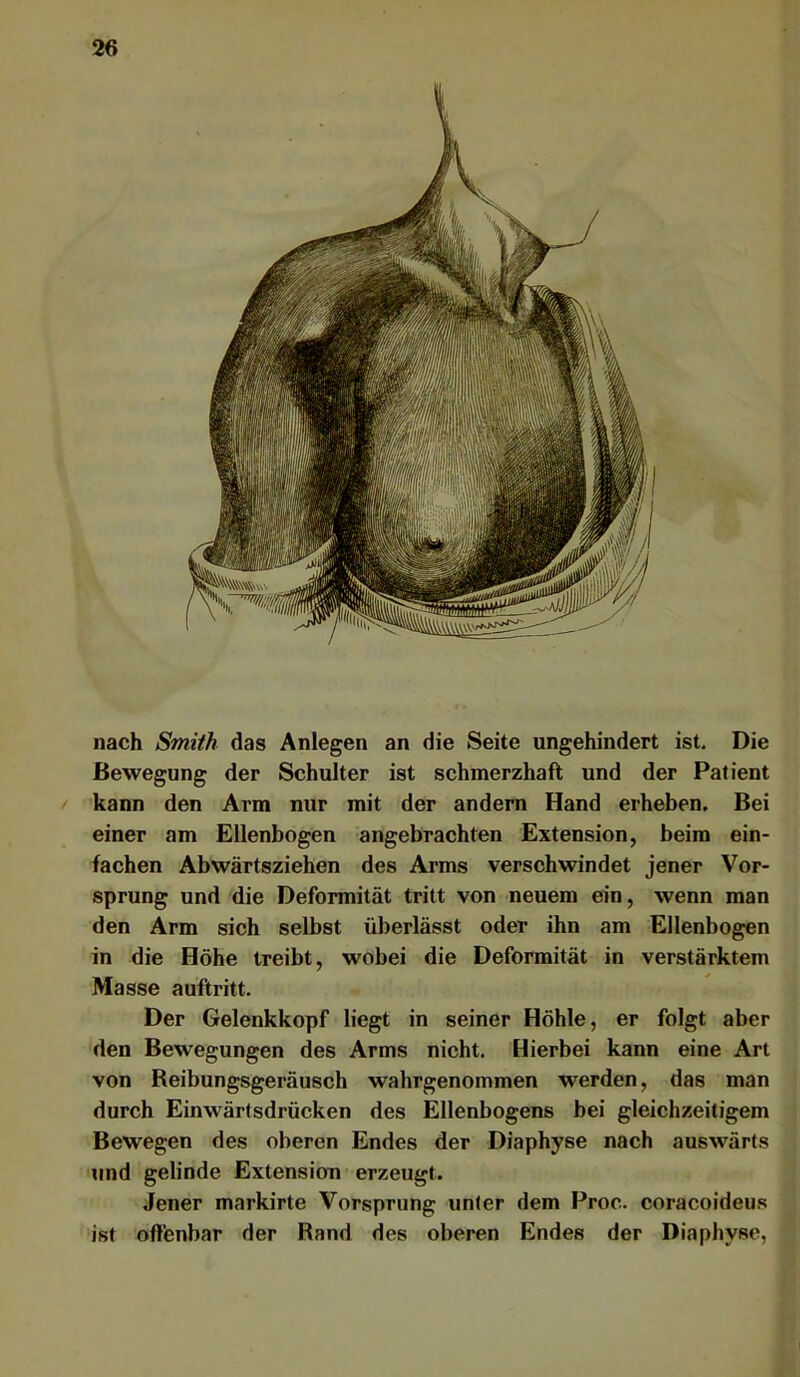 nach Smith das Anlegen an die Seite ungehindert ist. Die Bewegung der Schulter ist schmerzhaft und der Patient kann den Arm nur mit der andern Hand erheben. Bei einer am Ellenbogen angebrachten Extension, beim ein- fachen Abwärtsziehen des Arms verschwindet jener Vor- sprung und die Deformität tritt von neuem ein, wenn man den Arm sich selbst überlässt oder ihn am Ellenbogen in die Höhe treibt, wobei die Deformität in verstärktem Masse auftritt. Der Gelenkkopf liegt in seiner Höhle, er folgt aber den Bewegungen des Arms nicht. Hierbei kann eine Art von Reibungsgeräusch wahrgenommen werden, das man durch Einwärtsdrücken des Ellenbogens bei gleichzeitigem Bewegen des oberen Endes der Diaphyse nach auswärts und gelinde Extension erzeugt. Jener markirte Vorsprung unter dem Proc. coracoideus ‘ist offenbar der Rand des oberen Endes der Diaphyse,