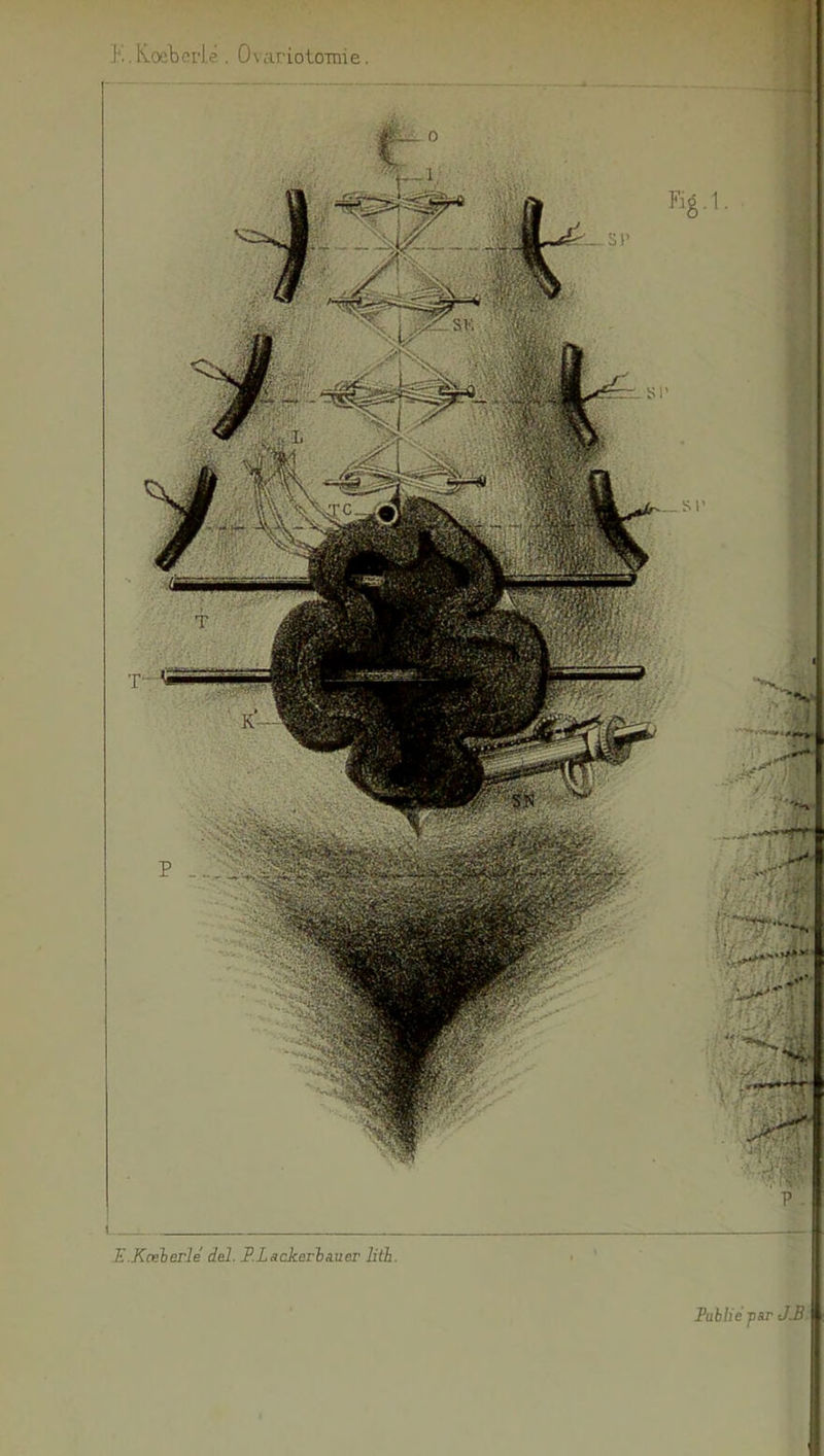 J‘..K.oebcrl.é . OvariotOTTiie. mm E.Kcelerle del. F.Lackeria.uer litb. Fabliéptir J£