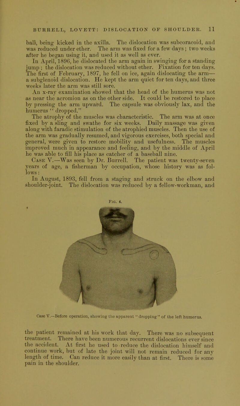 ball, being kicked in the axilla. The dislocation was subcoracoid, and was reduced under ether. The arm was fixed for a few days; two weeks after he began using it, and used it as well as ever. In April, 189(5, he dislocated the arm again in swinging for a standing jump ; the dislocation was reduced without ether. Fixation for ten days. The first of February, 1897, he fell on ice, again dislocating the arm— a subglenoid dislocation. He kept the arm quiet for ten days, and three weeks later the arm was still sore. An x-ray examination showed that the head of the humerus was not as near the acromion as on the other side. It could be restored to place by pressing the arm upward. The capsule was obviously lax, and the humerus “ dropped.” The atrophy of the muscles was characteristic. The arm was at once fixed by a sling and swathe for six weeks. Daily massage was given along with faradic stimulation of the atrophied muscles. Then the use of the arm was gradually resumed, and vigorous exercises, both special and general, were given to restore mobility and usefulness. The muscles improved much in appearance and feeling, and by the middle of April he was able to fill his place as catcher of a baseball nine. Case V.—Was seen by Dr. Burrell. The patient was twenty-seven years of age, a fisherman by occupation, whose history was as fol- lows ; In August, 1893, fell from a staging and struck on the elbow and shoulder-joint. The dislocation was reduced by a fellow-workman, and Fig. 4. Case V.—Before operation, showing the apparent “ dropping ” of the left humerus. the patient remained at his work that day. There was no subsequent treatment. There have been numerous recurrent dislocations ever since the accident. At first he used to reduce the dislocation himself and continue work, but of late the joint will not remain reduced for any length of time. Can reduce it more easily than at first. There is some pain in the shoulder.