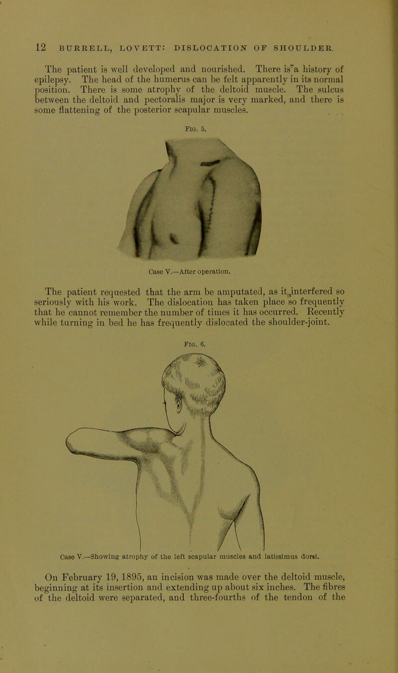 The patient is well developed and nourished. There is’a history of epilepsy. The head of the humerus can be felt apparently in its normal position. There is some atrophy of the deltoid muscle. The sulcus between the deltoid and pectoralis major is very marked, and there is some flattening of the posterior scapular muscles. Fig. 5. Case V.—After operation. The patient requested that the arm be amputated, as it.^interfered so seriously with his work. The dislocation has taken place so frequently that he cannot remember the number of times it has occurred. Recently while turning in bed he has frequently dislocated the shoulder-joint. Fig. 6. Case V.—Showing atrophy of the left scapular muscles and latissimus dorsi. On February 19,1895, an incision was made over the deltoid muscle, beginning at its insertion and extending up about six inches. The flbres of the deltoid were separated, and three-fourths of the tendon of the