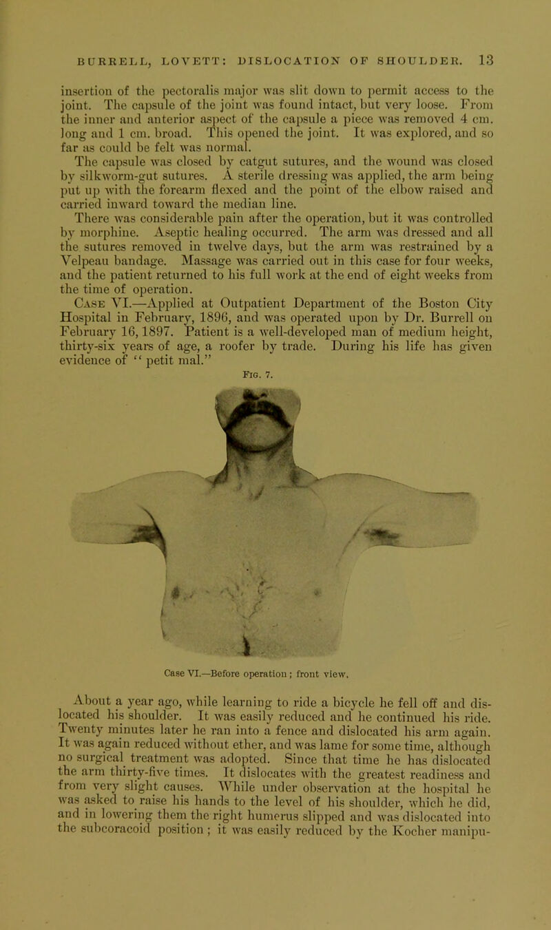 insertion of the pectoralis major was slit down to permit access to the joint. The capsule of the joint was found intact, but very loose. From the inner and anterior aspect of the capsule a piece was removed 4 cm. long and 1 cm. broad. This opened the joint. It was explored, and so far as could be felt was normal. The cajjsule was closed by catgut sutures, and the wound was closed by silkworm-gut sutures. A sterile dressing was applied, tbe arm being put up with the forearm flexed and the point of the elbow raised and carried inward toward the median line. There was considerable pain after the operation, but it was controlled by morphine. Aseptic healing occurred. The arm was dressed and all the sutures removed in twelve days, but the arm was restrained by a Velpeau bandage. Massage was carried out in this case for four weeks, and the patient returned to his full work at the end of eight weeks from the time of operation. Case VI.—Applied at Outpatient Department of the Boston City Hospital in February, 1896, and was operated upon by Dr. Burrell on February 16,1897. Patient is a well-developed man of medium height, thirty-six years of age, a roofer by trade. During his life has given evidence of “ petit mal.” Fig. 7. V Case VI.—Before operation ; front view. About a year ago, while learning to ride a bicycle he fell off and dis- located his shoulder. It was easily reduced and he continued his ride. Twenty minutes later he ran into a fence and dislocated his arm again. It was again reduced without ether, and was lame for some time, although no surgical treatment was adopted. Since that time he has dislocated the arm thirty-five times. It dislocates with the greatest readine.ss and from very slight causes. AVhile under ob.servation at the hospital he was Asked to raise his hands to the level of his shoulder, which he did, and in lowering them the right humerus slipped and was dislocated into the subcoracoid position ; it was easily reduced by the Kocher manipu-