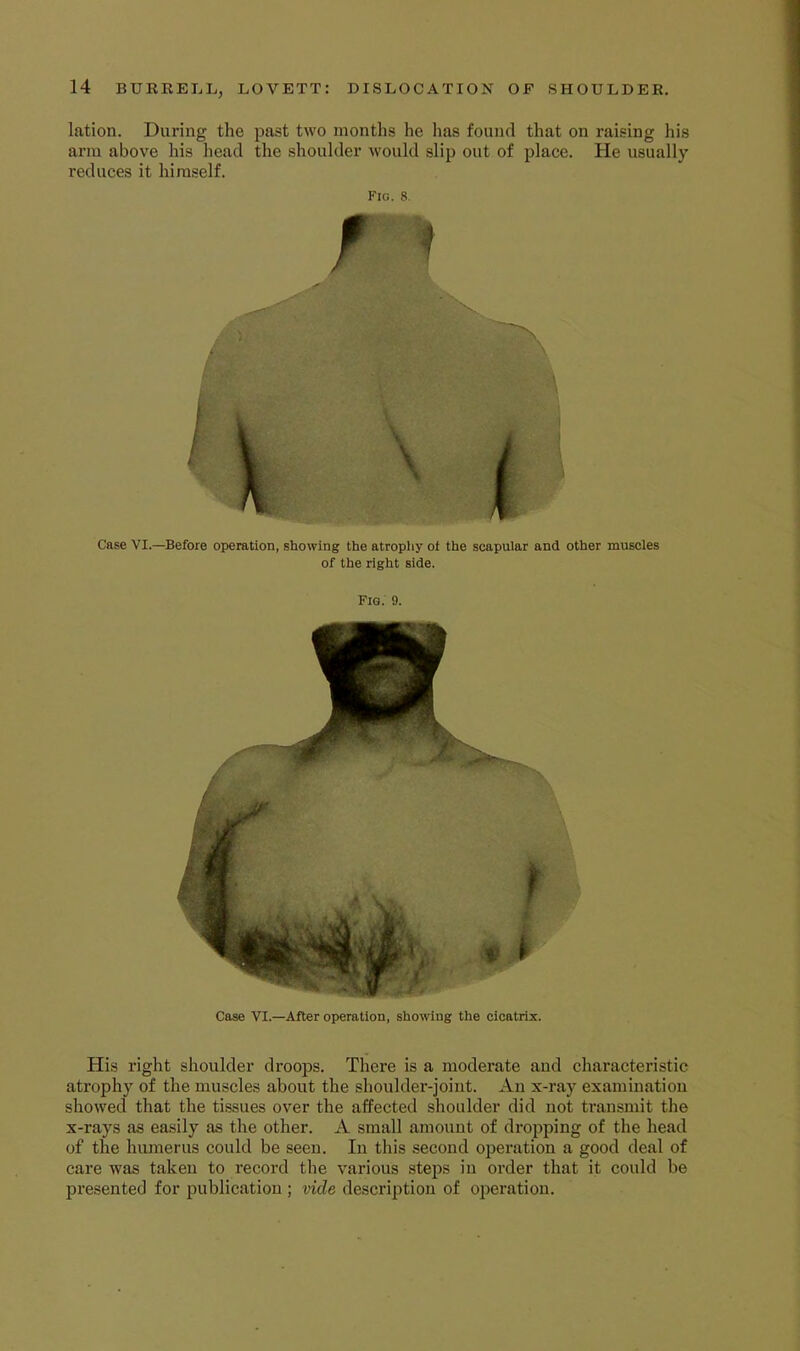 lation. During the past two months he has found that on raising his arm above his iiead the shoulder would slip out of place. Pie usually reduces it himself. Fig. 8. Case VI.—Before operation, showing the atropliy oi the scapular and other muscles of the right side. Fig. 9. Case VI.—After operation, showing the cicatrix. His right shoulder droops. There is a moderate and characteristic atrophy of the muscles about the shoulder-joint. An x-ray examination showed that the tissues over the affected shoulder did not transmit the x-rays as easily as the other. A small amount of dropping of the head of the humerus could be seen. In this second operation a good deal of care was taken to record the various steps in oi’der that it could be presented for publication ; vide description of operation.