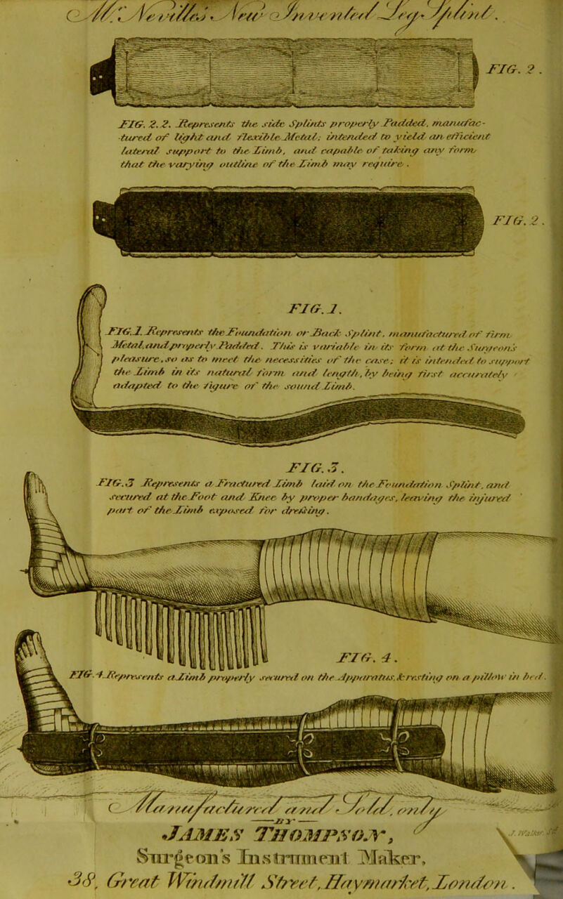 ^ICr. 2,2. JtefireJe/iYj t/t& .ride Spli/ity properfy Padded, nuuiufac- ■tured op h'ffht ayid- pleJcH>tc,JffcPd; uitended tv yield, a/t effleieed Udetrd sn/>port tv die Xunii, and rapalde oP taPiny any rornv tAat die varyint/ outline op the Ximh may rnfuire , FJG. 2. rjfr.j. FTli.J. Jiepnvmt.e the Foundation orJBaeP Splint, nianuPaetu/vd oP Ptrm. MetalatulproperlyPiiddeti, Tithe ir varialde unity Por/n id the .fim/eo/iy plnisurc.so as tv meet die. neees.titirs id' the case; it is intended to jeuppor-t die .Limh in its natuntl tri/'/n attd lenyth, hy heituf ti/st aeru/ntelv adapted to die t'ufiwc oP the sound Timh. *tt /tt//rir/u/22^^ JpLMES Thomj\vo.y» Siu'^eon’s Iiistrnineiii IMalkcT. {r/yy/^ TVfhi////iy/ Sf?ri‘/, fft'/y//ii/r/iYfi,JtPip/ifF/i r n'jiitv- TIG.3. FIfi,3 Feprr.tents a.Fruetu/rd Timh fairl on the Foundation Sp/int, and •feeured at the Foot cutd- Knee, hy pri>per handnyes, lenvinr/ the iti/ured patt oP dieFimh e.i-posrd tor drrtiiny. FTd.dFepnwents aFitnhprtifii'rly .reeuml on the .lppartitus,A'-rr.rtiny on etpi/loW in her/