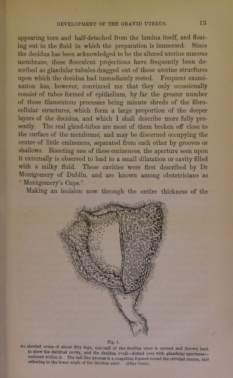cappearing torn and half-detached from the lamina itself, and float- ing out in the fluid in which the preparation is immersed. Since the decidua has been acknowledged to be the altered uterine mucous membrane, these flocculent projections have frequently been de- scribed as glandular tubules dragged out of those uterine structures upon which the decidua had immediately rested. Frequent exami- nation has, however, convinced me that they only occasionally consist of tubes formed of epithelium, by far the greater number of these filamentous processes being minute shreds of the fibro- ceUular structures, which form a large proportion of the deeper layers of the decidua, and which I shall describe more fully pre- sently. The real gland-tubes are most of them broken ofiT close to the surface of the membrane, and may be discerned occupying the centre of little eminences, separated from each other by grooves or shallows. Bisecting one of these eminences, the aperture seen upon it externally is observed to lead to a small dilatation or cavity fiUed •with a milky fluid. These ca’vdties were first described by Dr Montgomery of Dublin, and are known among obstetricians as “ Montgomery’s Cups.” Making an incision now through the entire thickness of the Fig. 1. An aborted ovum of about fifty days, one-lmlf of the decidua uteri is opened and thrown back to shew the decidual cavity, and the decidua ovuli—dotted over with glandular apertures endosed within it. Tlie tail-like process is a coagulum formed round the cervical mucus, and adhering to the lower angle of the decidua uteri. (After Coste%