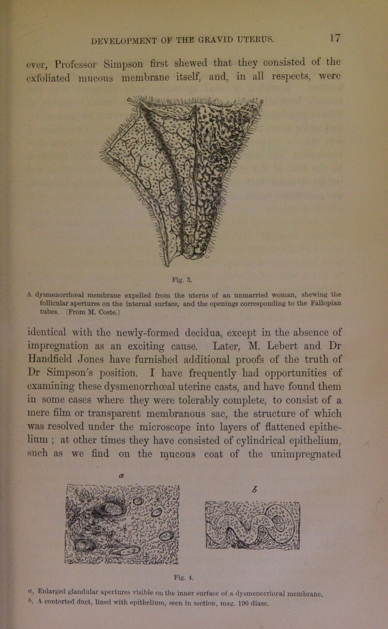 ever, Professor Simpson fii-st shewed that they consisted of the exfoliated mucous membrane itself, and, in all respects, were Fi«. 3. A dysmenorrhoeal membrane expelled from the uterus of an unmarried woman, shewing the follicular apertures on the internal surface, and the openings corresiwnding to the Fallopian tubes. (From M. Coste.) identical with the newly-formed decidua, except in the absence of impregnation as an exciting cause. Later, M. Lebert and Dr Handheld Jones have furnished additional proofs of the truth of Dr Simpson’s position. I have frequently had opportunities of examining these dysmenorrhoeal uterine casts, and have found them in some cases where they were tolerably complete, to consist of a mere film or transparent membranous sac, the structure of which was resolved under the microscope into layers of flattened epithe- lium ; at other times they have consisted of cylindrical epithelium, such as we find on the mucous coat of the unimjiregnated a Fig. 4. a. Enlarged glandular aportiu'ci> \’iiiible ou tlic inner surface of a dyxmcnoiTliu'al membrane, fi, A contorted duct, lined «ith epithelium, seen in section, mag. 190 diam.
