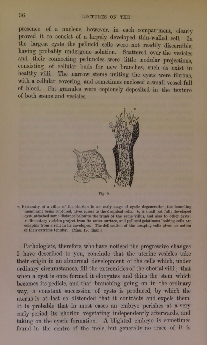 3G presence of a nucleus, however, in each compartment, clearly proved it to consist of a largely developed thin-walled cell. In the largest cysts the pellucid cells were not readily discernible, having probably undergone solution. Scattered over the vesicles and their connecting peduncles were little nodular projection.s, consisting of cellular buds for new branches, such as exist in healthy villi. The narrow stems uniting the cysts were fibrous, with a cellular covering, and sometimes enclosed a small vessel full of blood. Fat granules were copiously deposited in the texture of both .stems and vesicles. • a Fig. 9. n, ExlrcmUy of a villiia of the chorion in an early stage of cystic degeneration, Uic Iwunding membrane being niptnred, gives egress to the dropsical cells, b, A small bnt fully developed cyst, attached some distance below to the trunk of the same villus, and also to other cysts ; rudimentary vesicles project from its outer surface, and pellucid gelatinous-looking cells are escaping from a rent in its envelopes. The delineation of the escaping cells gives no notion of their extreme tenuity. (Mag. 100 diam.) Pathologists, therefore, who have noticed the progressive changes I have described to you, conclude that the uterine vesicles take their origin in an abnormal development of the cells which, under ordinary circumstances, fill the extremities of the chorial villi; that when a cyst is once formed it elongates and thins the stem which becomes its pedicle, and that branching going on in the ordinary way, a constant succession of cysts is produced, by which the uterus is at last so distended that it contracts and expels tliem. It is probable that in most cases an embryo perishes at a very early period, its chorion vegetating independently afterv’ards, and taking on the cystic formation, A blighted embryo is sometimes found in the centre of the mole, but generally no trace of it is