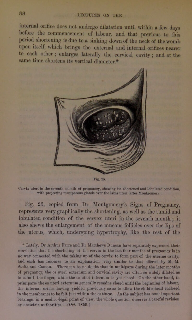 8» LEtTUHES ON THE internal orifice does not undergo dilatation until within a few days before the commencement of labour, and that previous to this period shortening is due to a sinking down of the neck of the womb upon itself, which brings the external and internal orifices nearer to each other ; enlarges laterally the cervical cavity; and at the same time shortens its vertical diameter.* Fig. 2S. Cervix uteri in the seventh month of pregnancy, sliewing its sliortened and lobulated condition, with projecting muciparous glands over the labia uteri (after Montgomery). Fig. 25, copied from Dr IMontgomery’s Signs of Pregnancy, represents very graphically the shortening, as w’ell as the tumid and lobulated condition of the cervex uteri in the seventh month ; it also shew's the enlargement of the mucous follicles over the lips of the uterus, which, undergoing hypertrophy, like the rest of the * Lately, Dr Arthur Farre and Dr Matthews Duncan have separately expressed their conviction that the shortening of the cervix in the last four months of pregnancy is in no way connected with the taking up of the cervix to form part of the uterine cavity, and each has recourse to an explanation very similar to that offered by M. M. Stoltz and Cazeau. There can be no doubt that in multiparae during the later months of pregnancy, the os uteri externum and cervical cavity are often so widely dilated as to admit the finger, while the os uteri internum is yet closed. On the other hand, in primiparse the os uteri externum generally remains closed until the beginning of labour, the internal orifice having yielded previously so as to allow the child’s head enclosed in the membranes to be felt just within the os tine®. As the subject has some important bearings, in a medico-legal point of view, the whole question deserves a careful revision by obstetric authorities.—{Oct. 1869.)